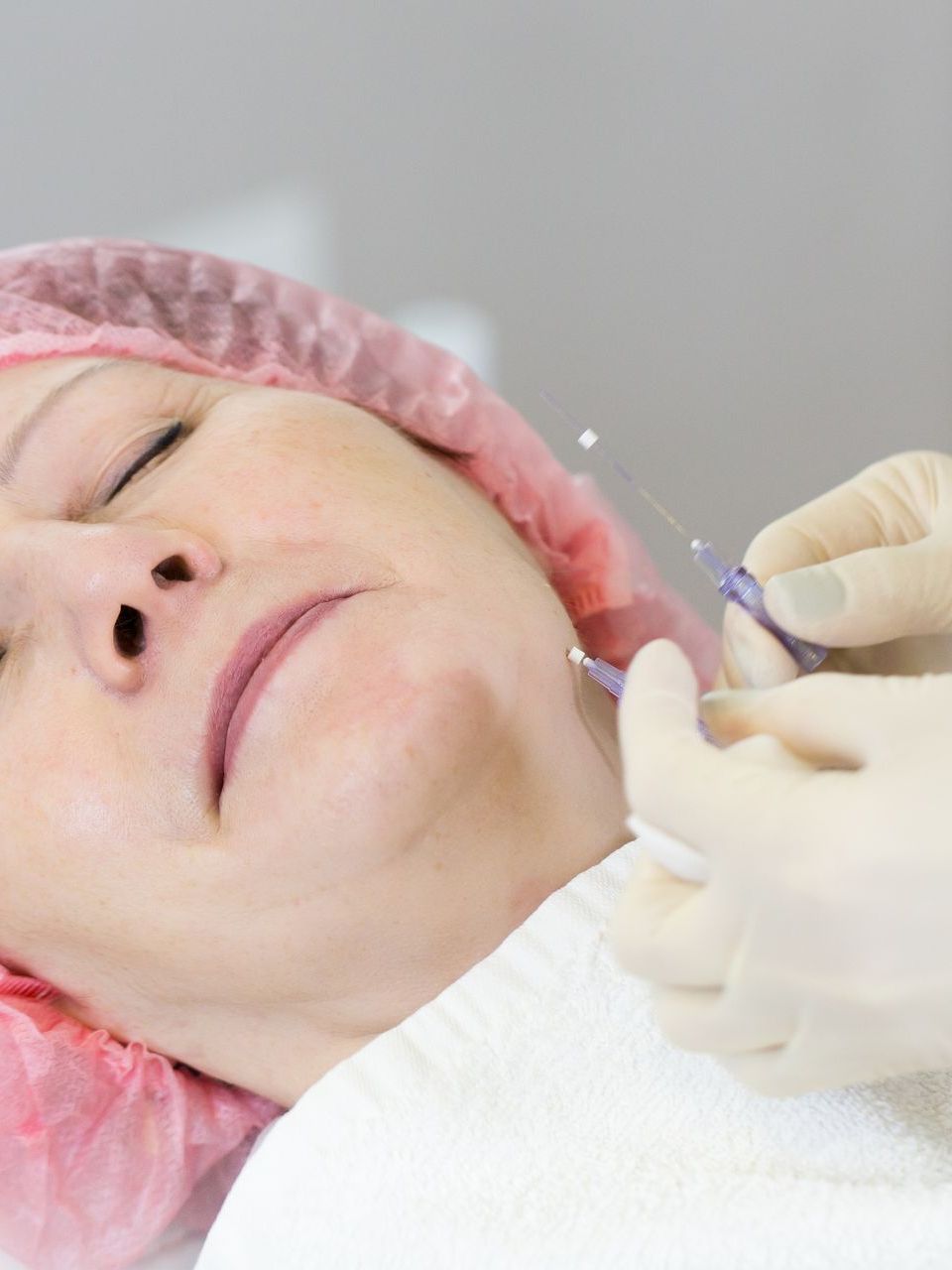 woman getting thread lift