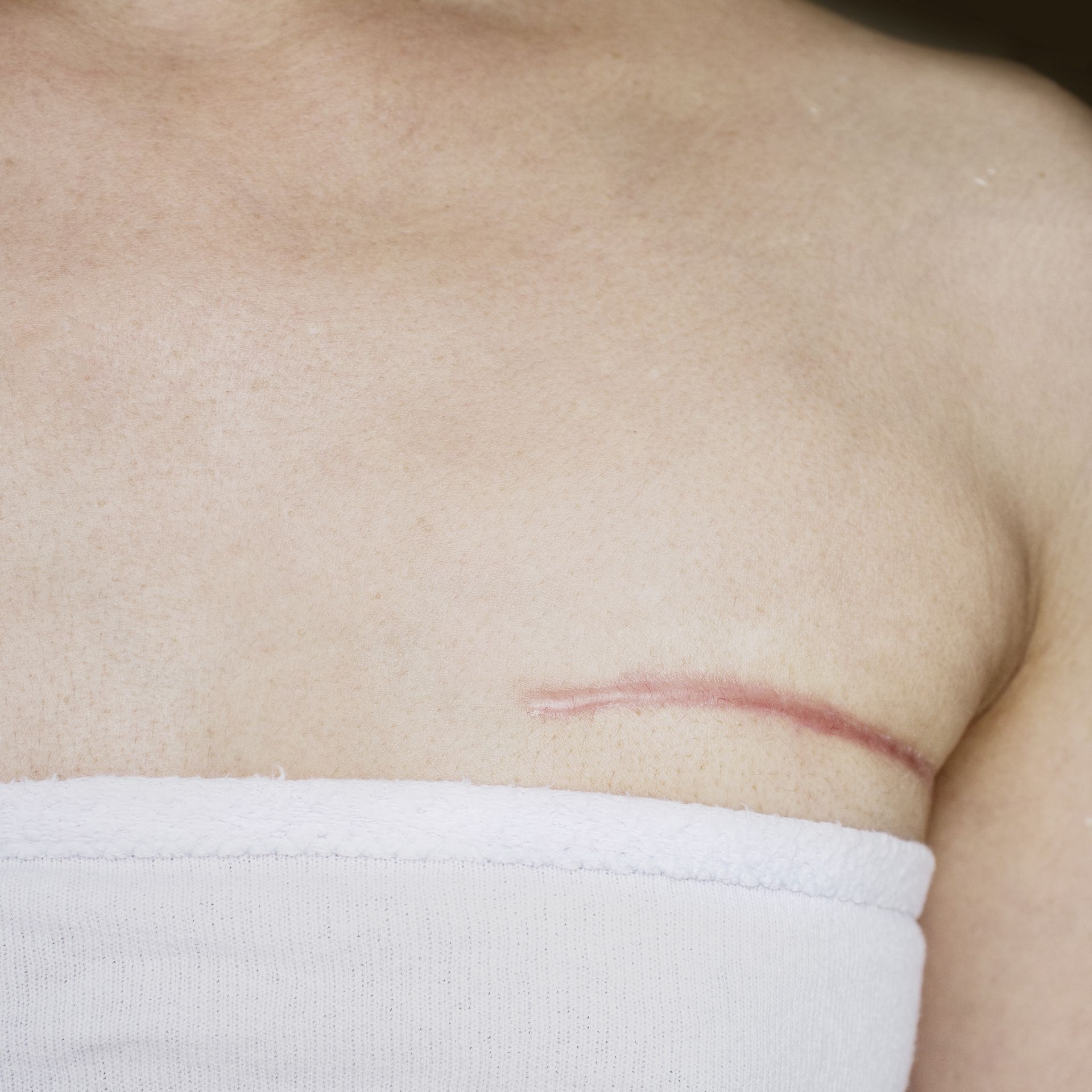 breast cancer surgery scar