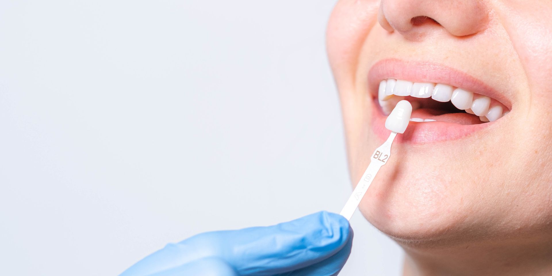 Mano guantata che applica il fluoro dentale sui denti di una persona sorridente con un applicatore a spazzolino.