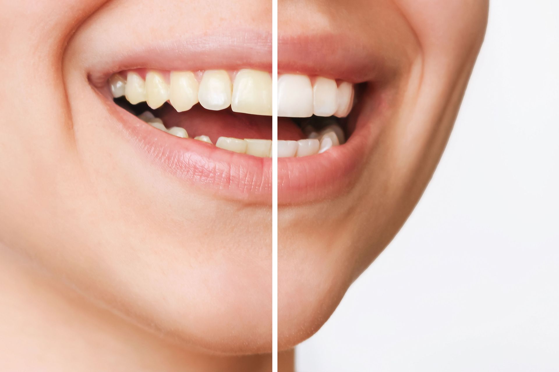 Primo piano di una bocca sorridente con denti sani, divisa da una linea verticale che mostra il prima e il dopo lo sbiancamento.
