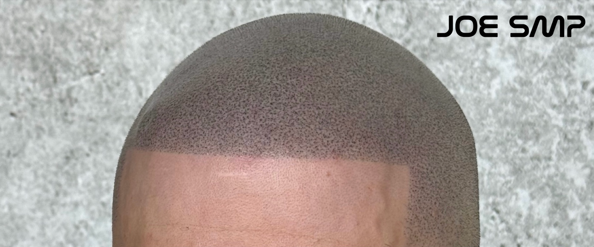 Close-up of a scalp with Scalp Micropigmentation (SMP), a cosmetic procedure for hair loss.