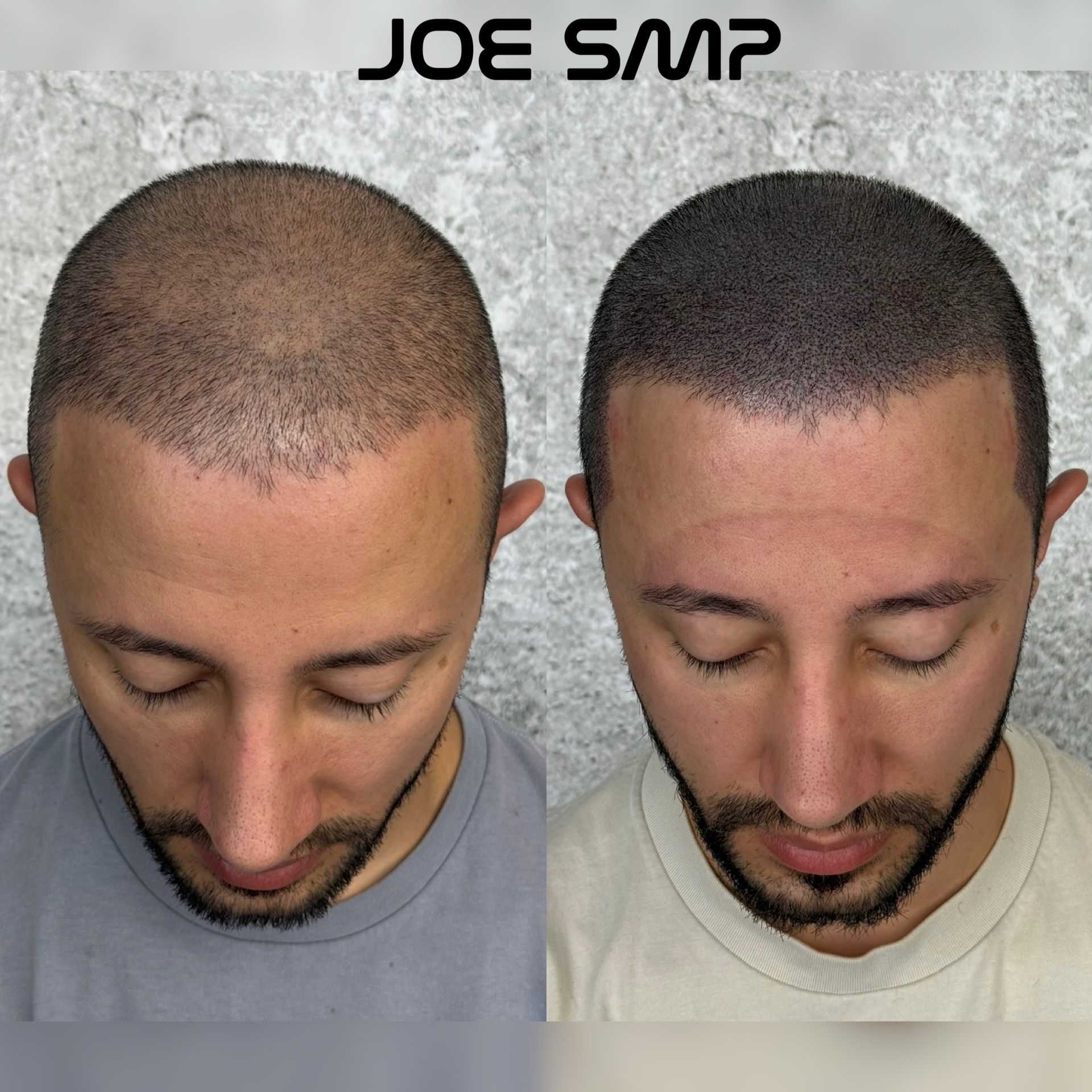 Before-and-after scalp micropigmentation on a man: bald head with sparse hair to a head with a denser, darker hairline.