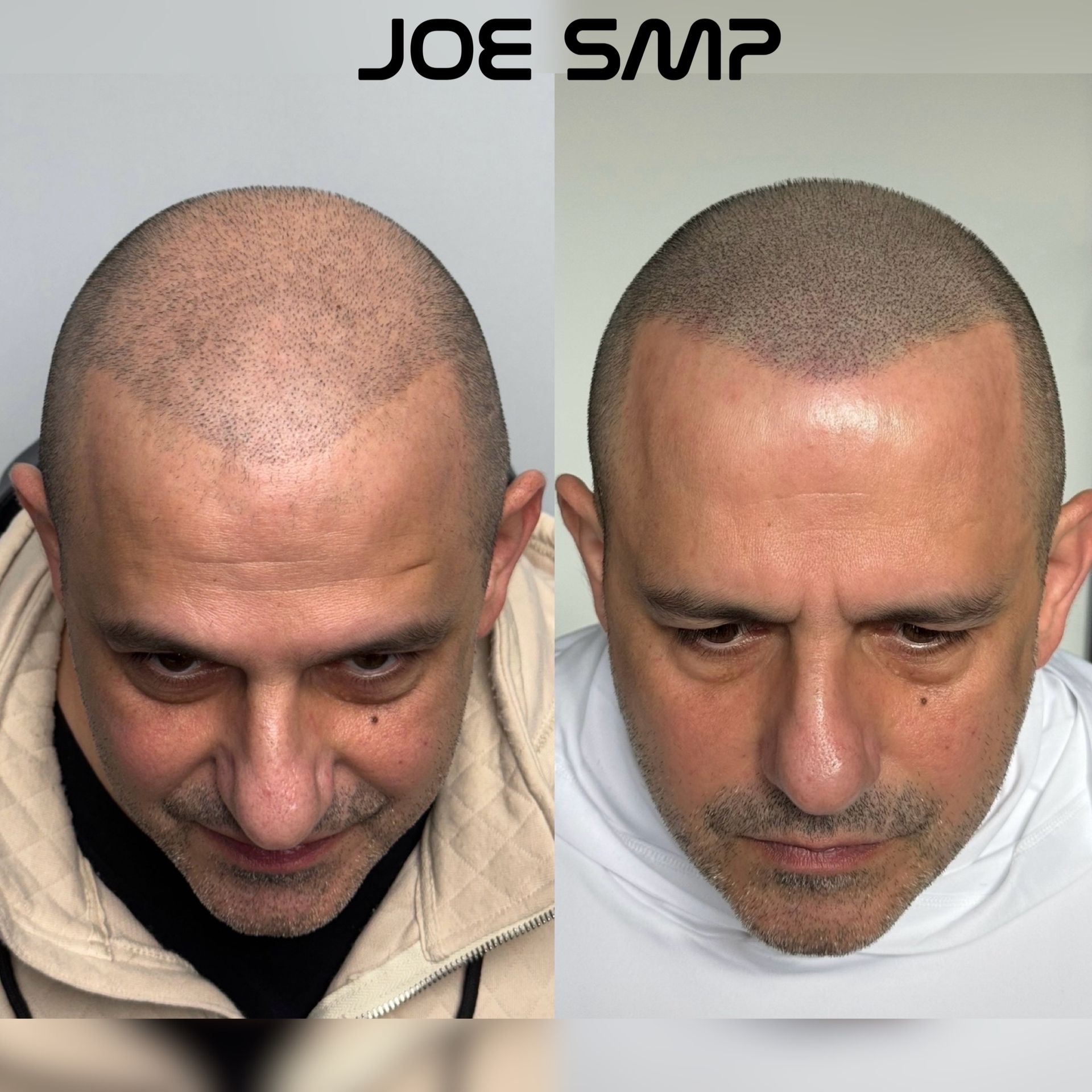 Scalp micropigmentation before and after. Bald man with thinning hair transformed to a full, shaved-head look.