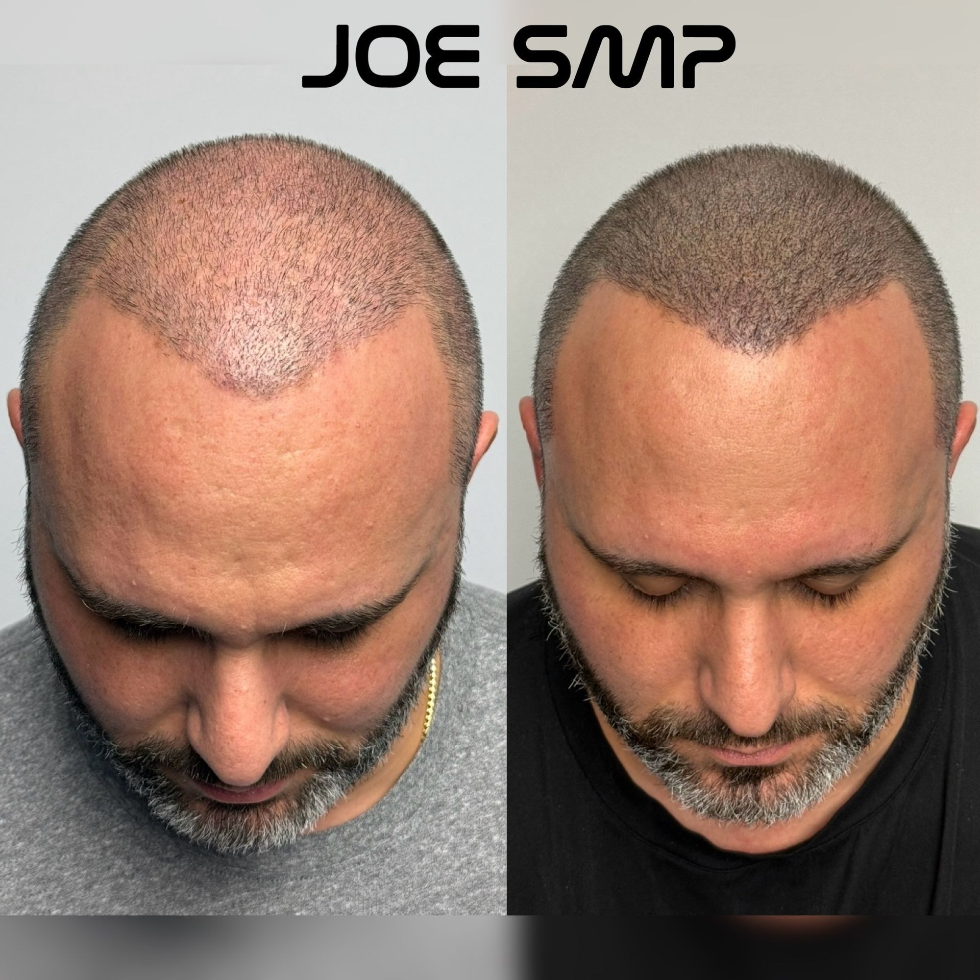 Side-by-side view of a man's head, before and after scalp micropigmentation. The