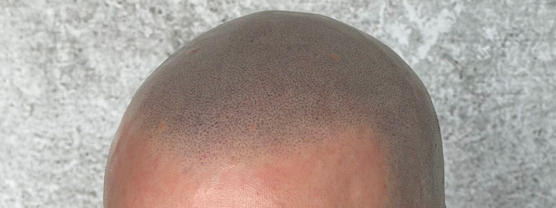Close-up of a shaved head with scalp micropigmentation, creating a hairline effect.