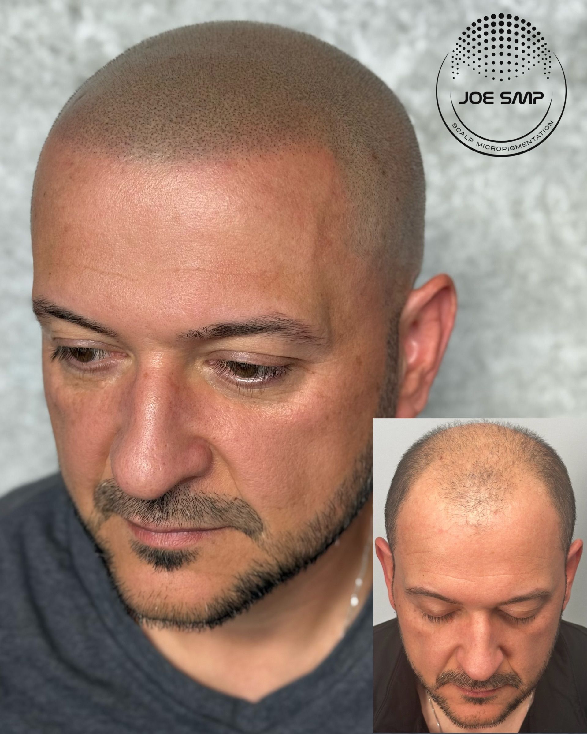 Man with shaved head and scalp micropigmentation, before and after view.