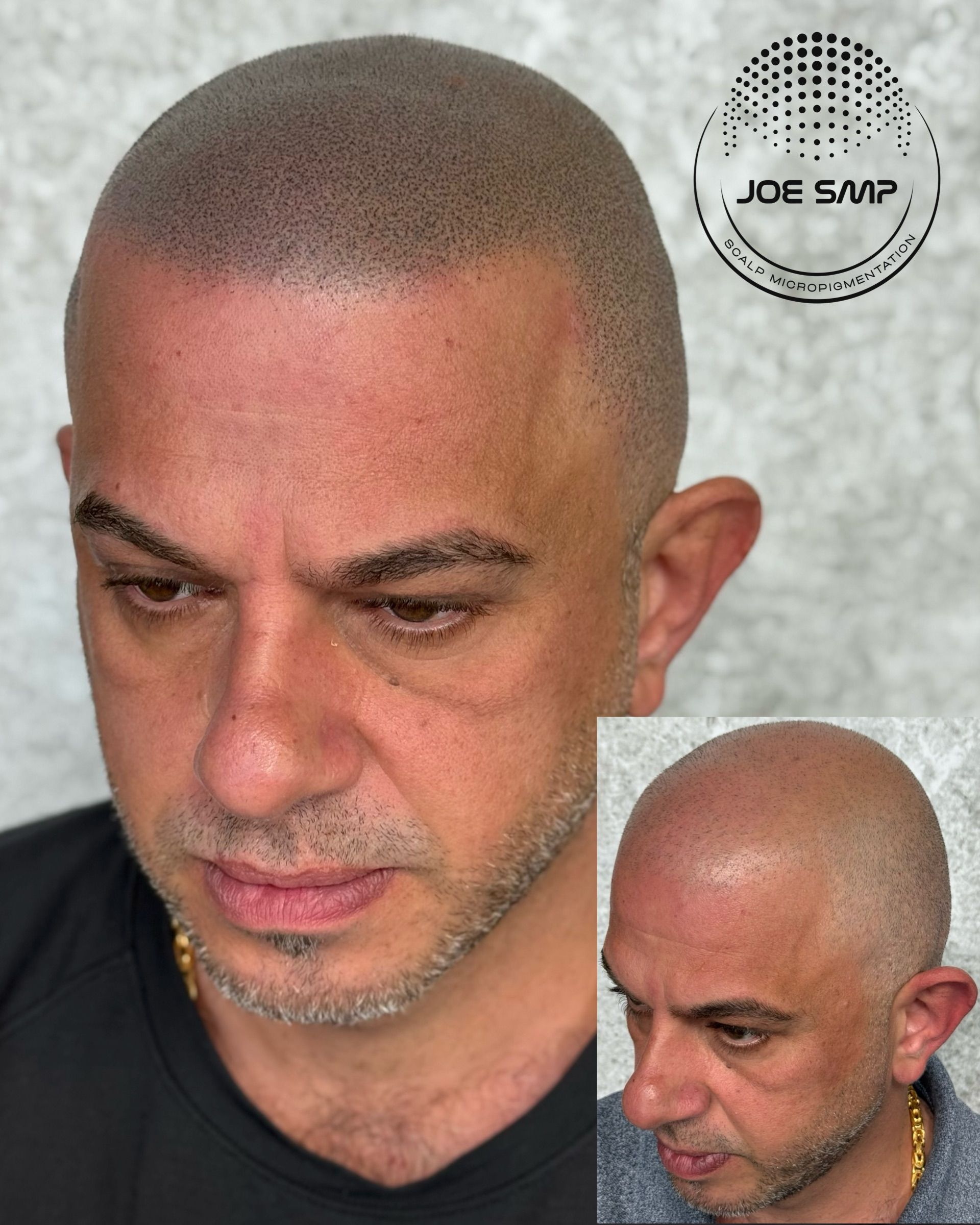 Man with shaved head, before-and-after SMP treatment. Scalp has dark dots, improving appearance of hair loss.