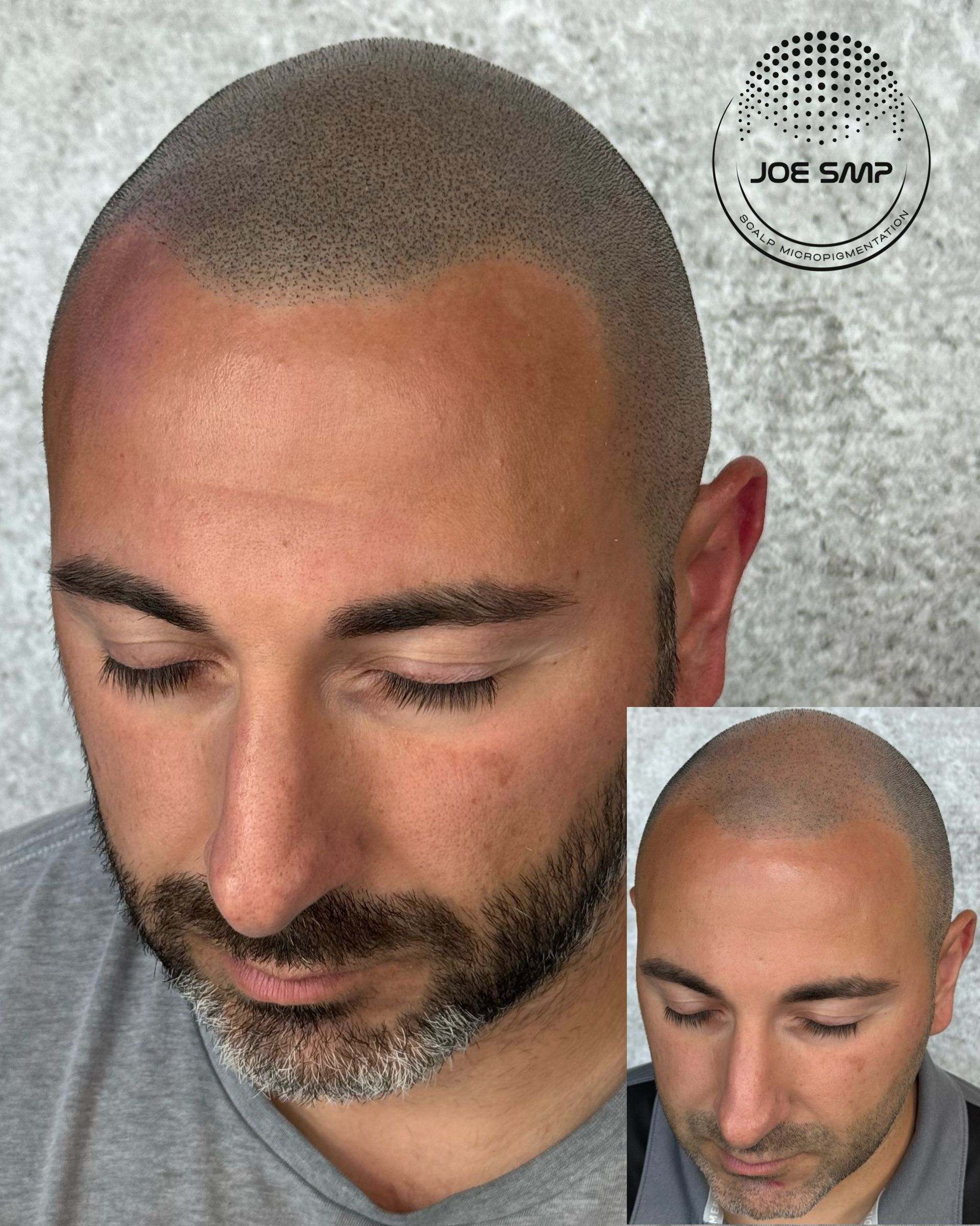 Man with scalp micropigmentation; before and after inset shows hair loss treatment.