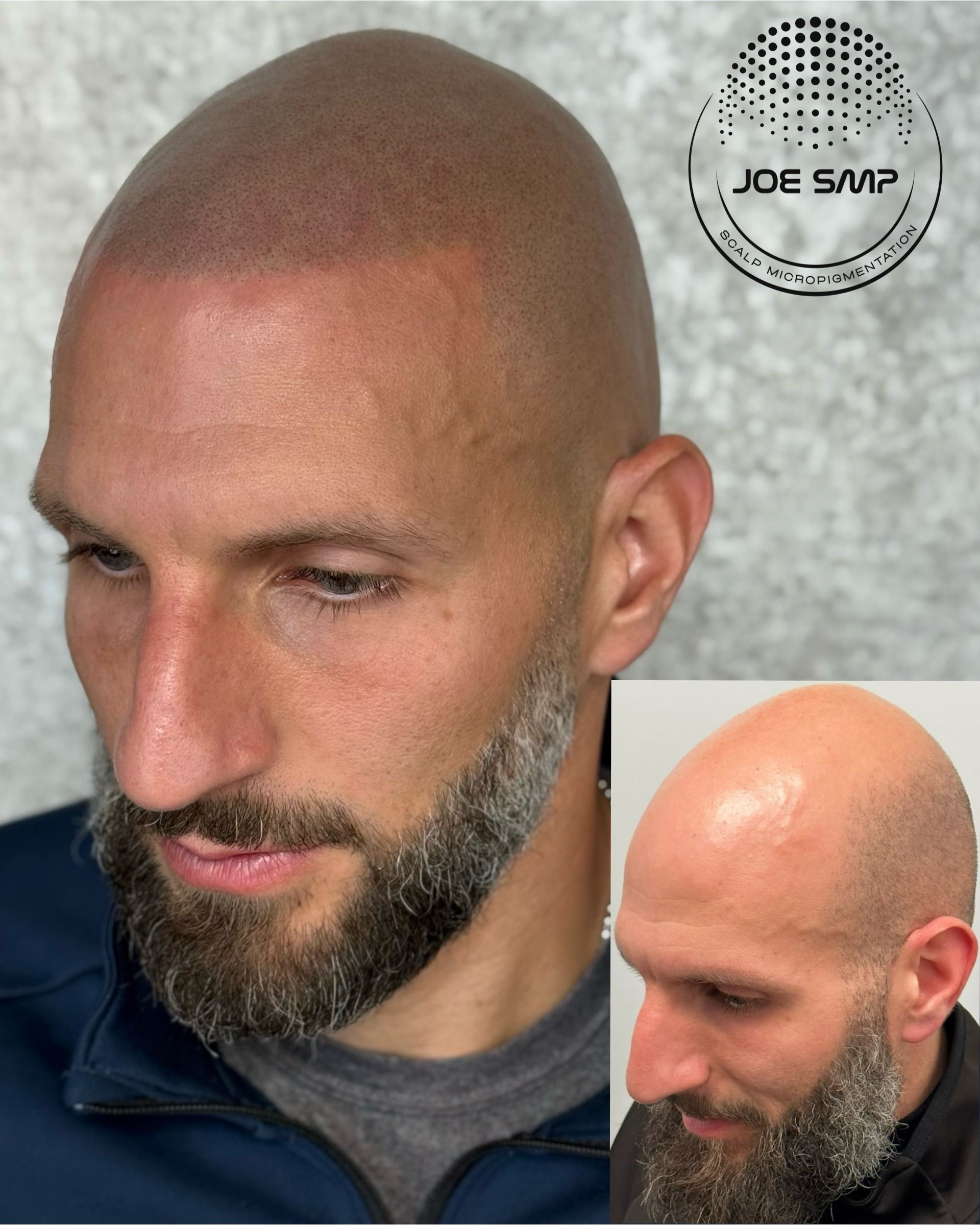 Man with shaved head and beard, undergoing scalp micropigmentation; before/after comparison.