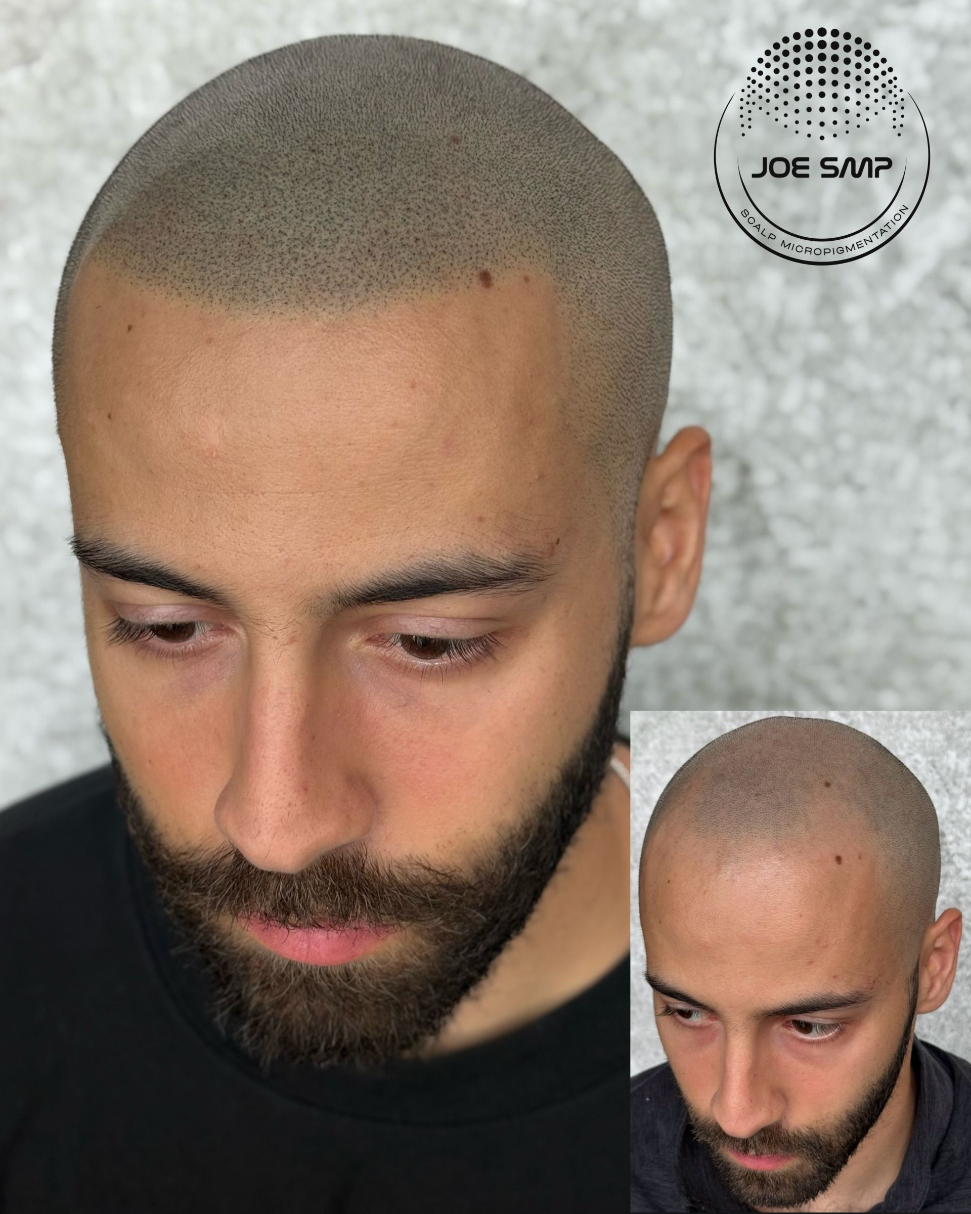 Scalp Micropigmentation on a man with a beard, mimicking a shaved head. Gray pigment and close-up view.