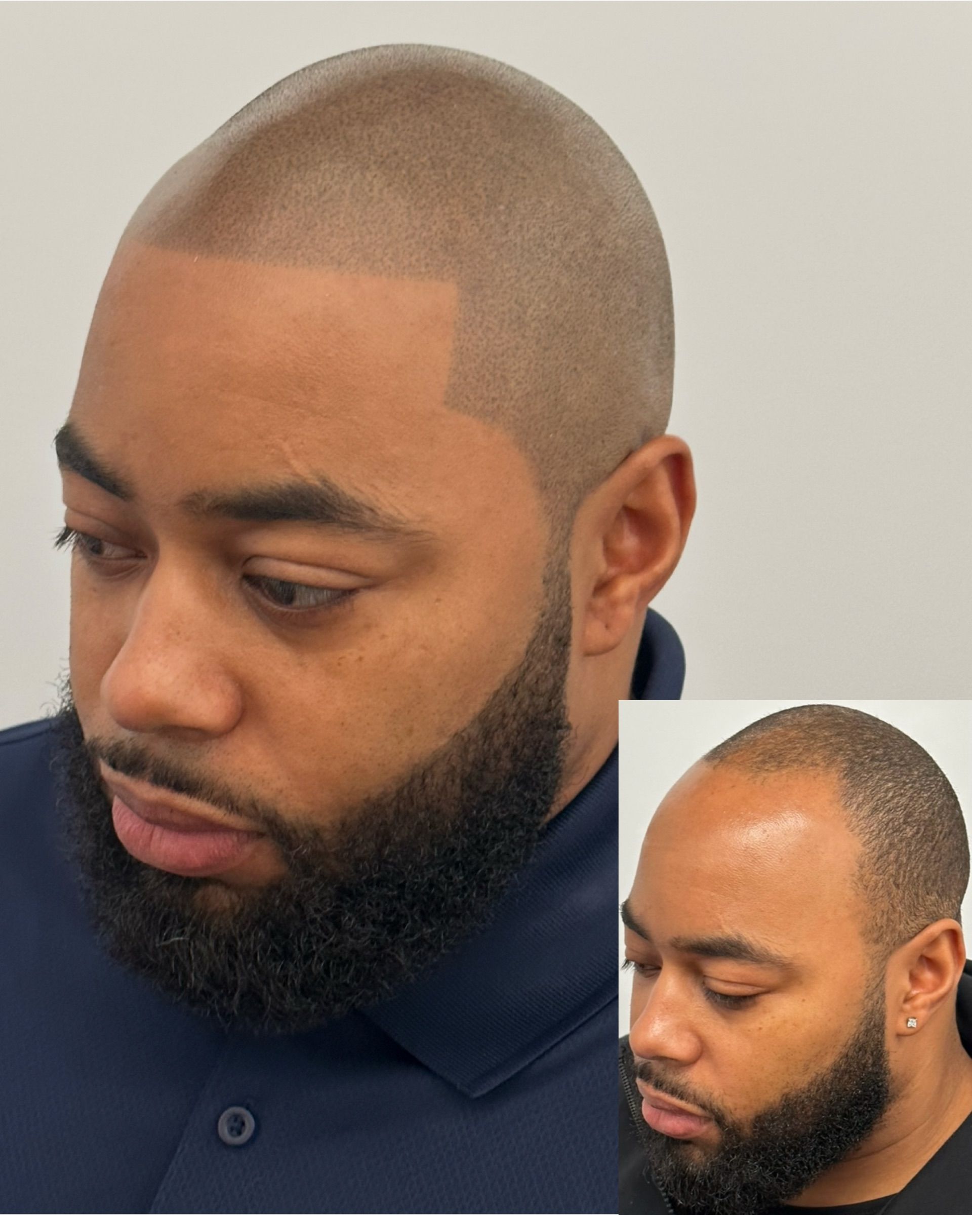 Man with a shaved head and beard, comparison shows before and after with hairline correction.