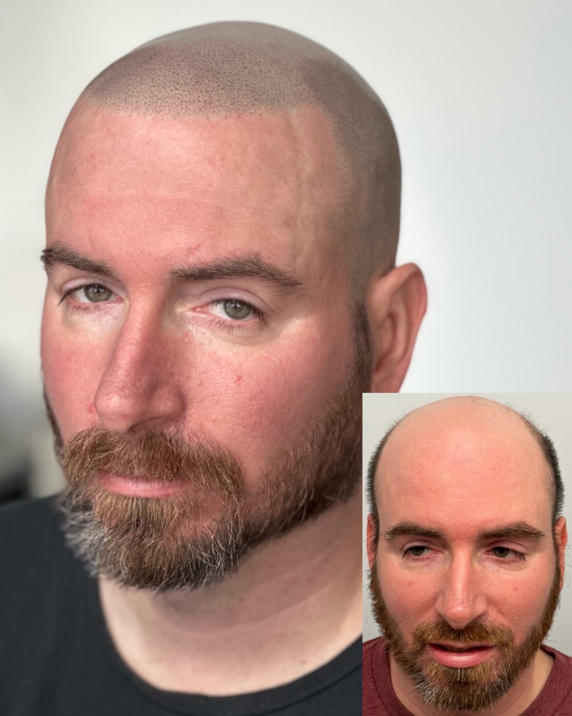 Man with shaved head and stubble before and after Scalp Micropigmentation.