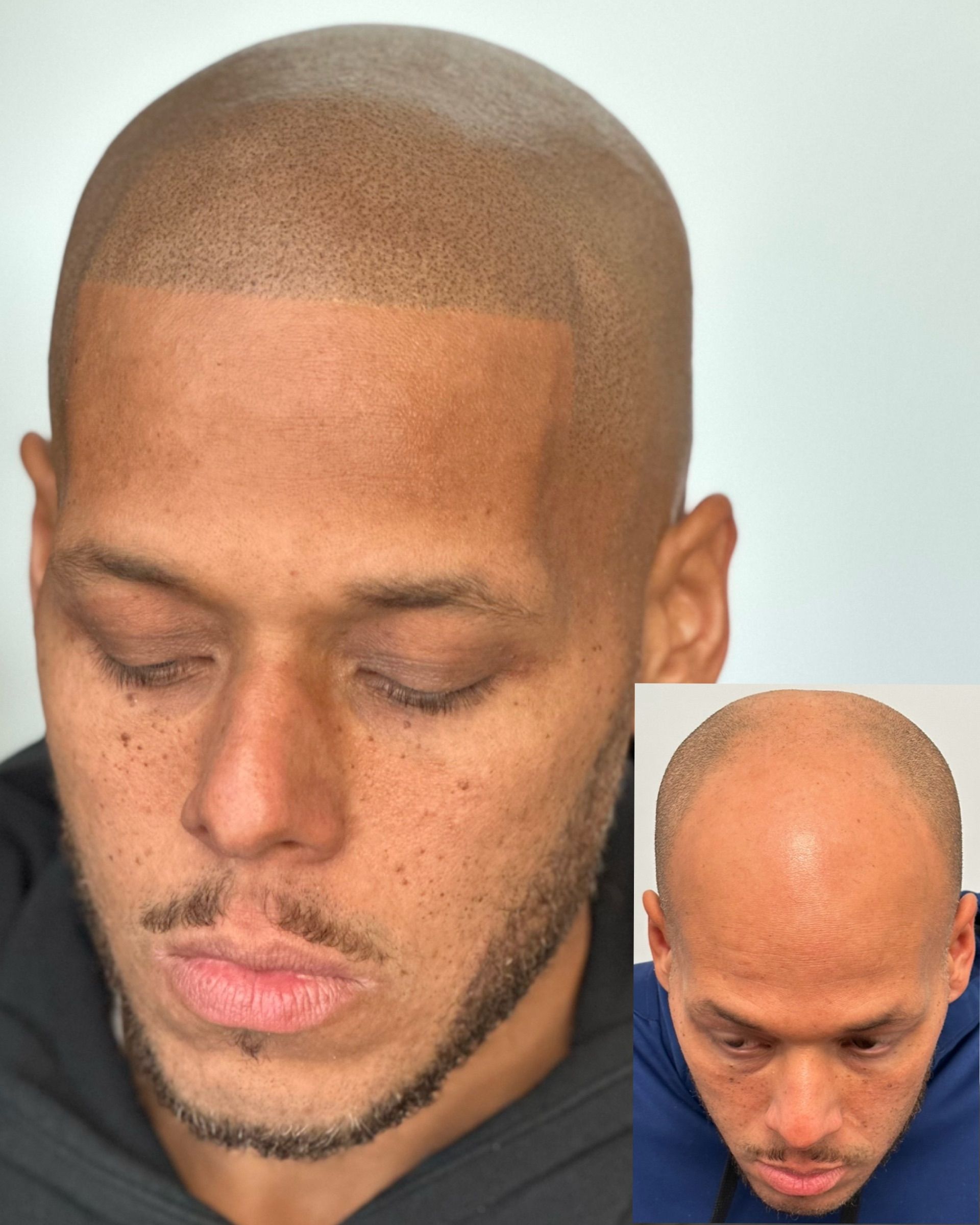 Man with shaved head; scalp micropigmentation simulates a fuller hairline. Inset shows balding.
