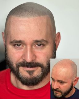 Man with scalp micropigmentation, full beard; inset shows before photo.
