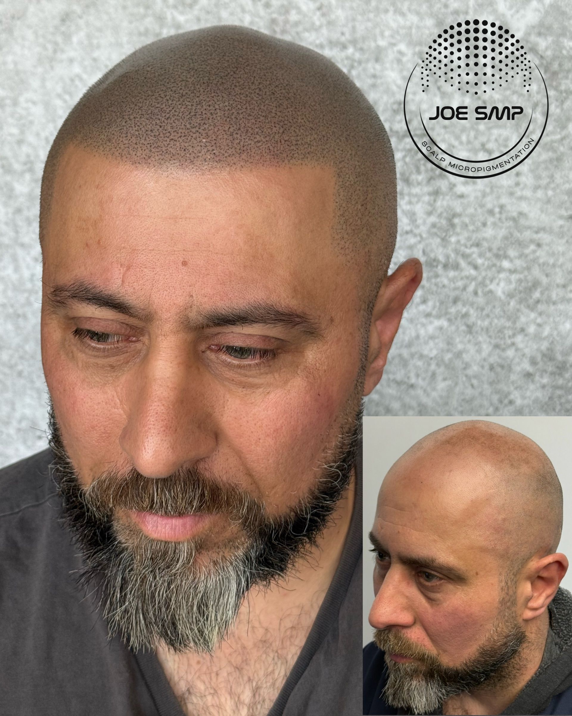 Man with scalp micropigmentation, showcasing before and after. Dark hair dots mimicking a shaved head.