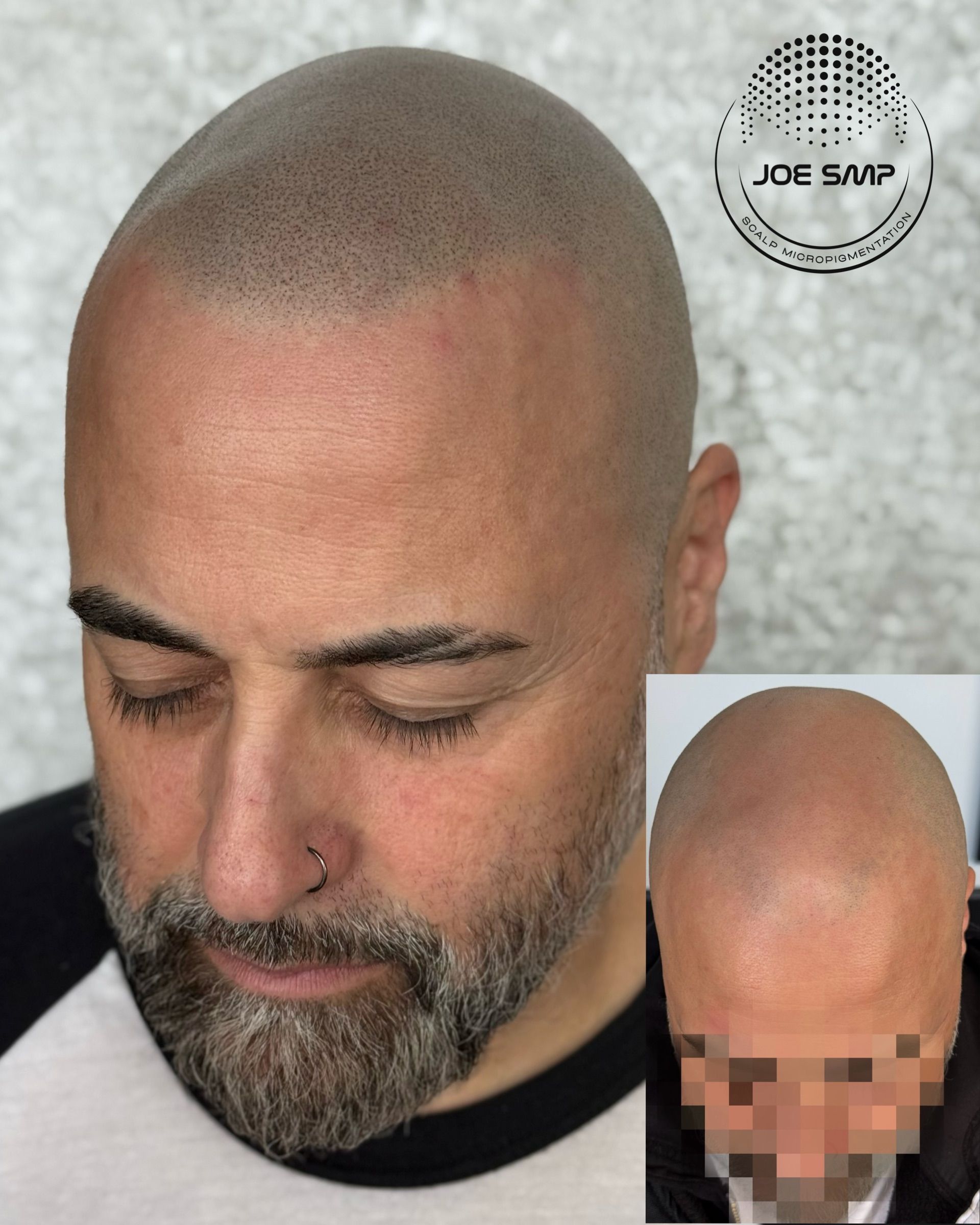Man with shaved head, undergoing scalp micropigmentation. Inset shows before photo with blurred face.