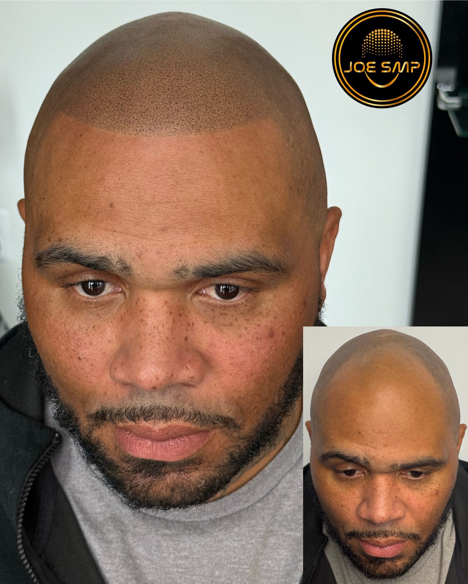 Man with scalp micropigmentation, showcasing before-and-after results. Dark dots on the scalp, light skin tone.