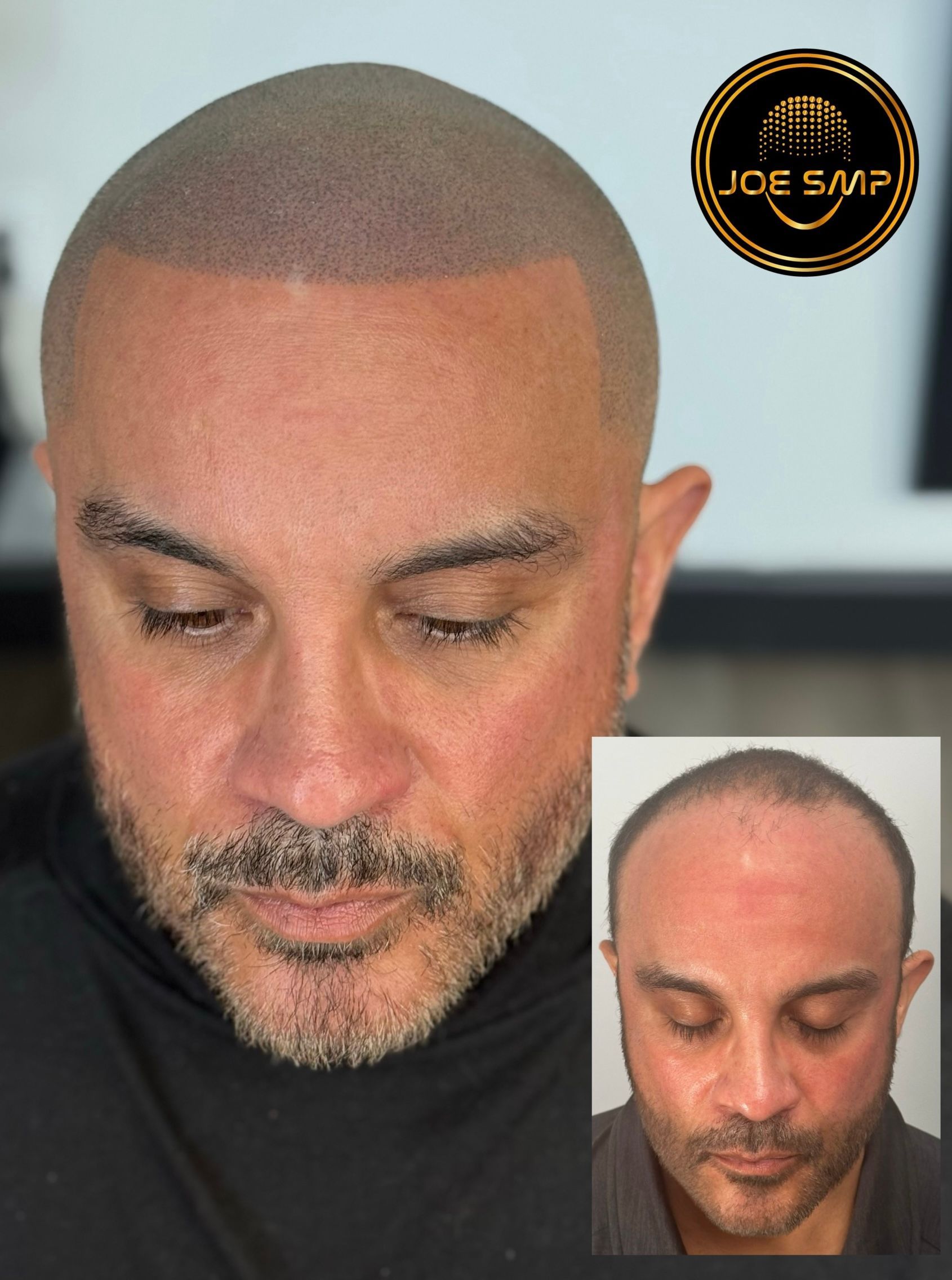 Man's head with scalp micropigmentation, showcasing before-and-after results. Close-up shot with inset photo.