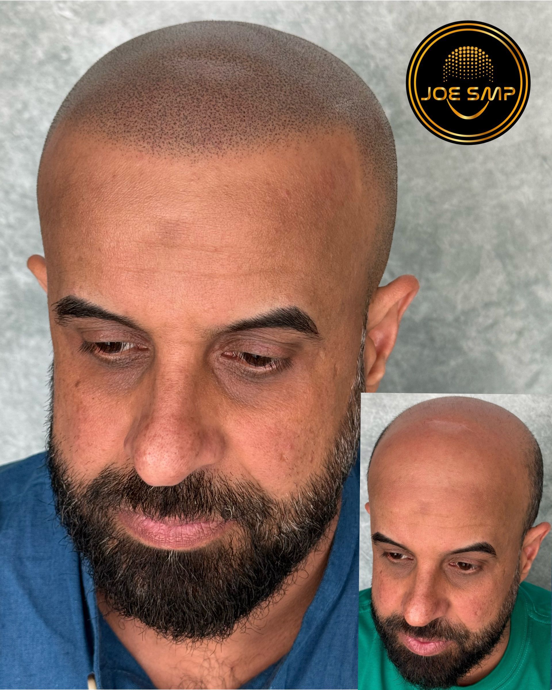 Man with scalp micropigmentation, showing before and after views. Dark stubble, shaved head with dark dots.