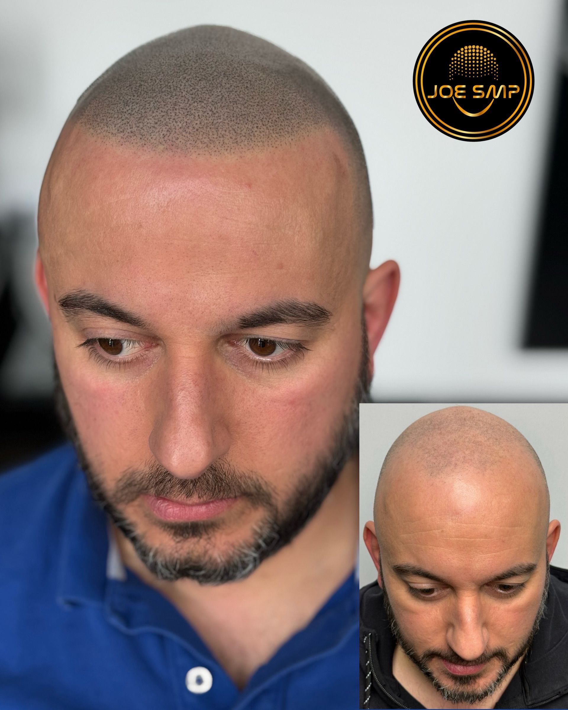 Man with scalp micropigmentation, showcasing before-and-after results. Dark dots simulate hair follicles.