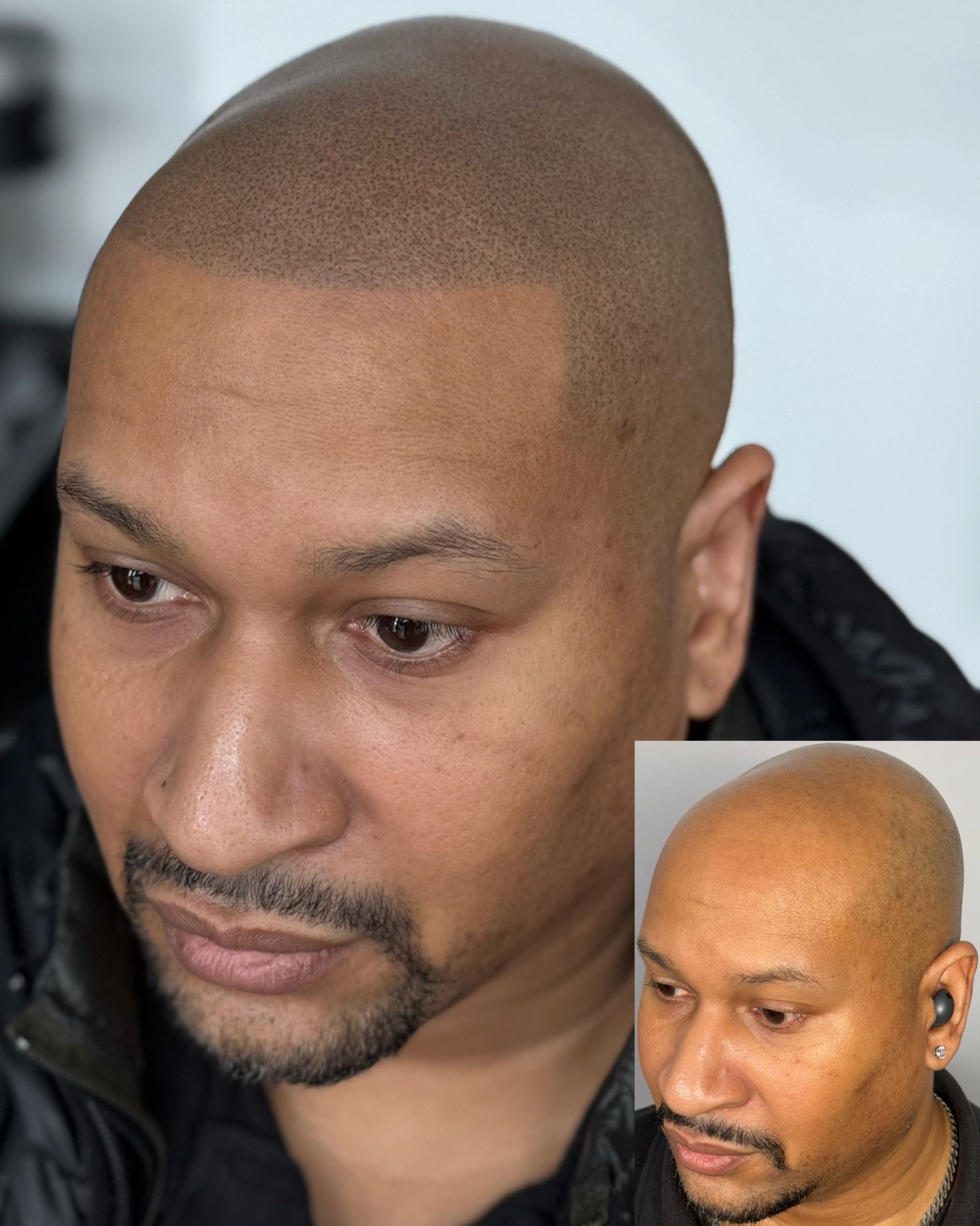 Man with scalp micropigmentation, showcasing before-and-after. Dark dots create the appearance of a shaved head.