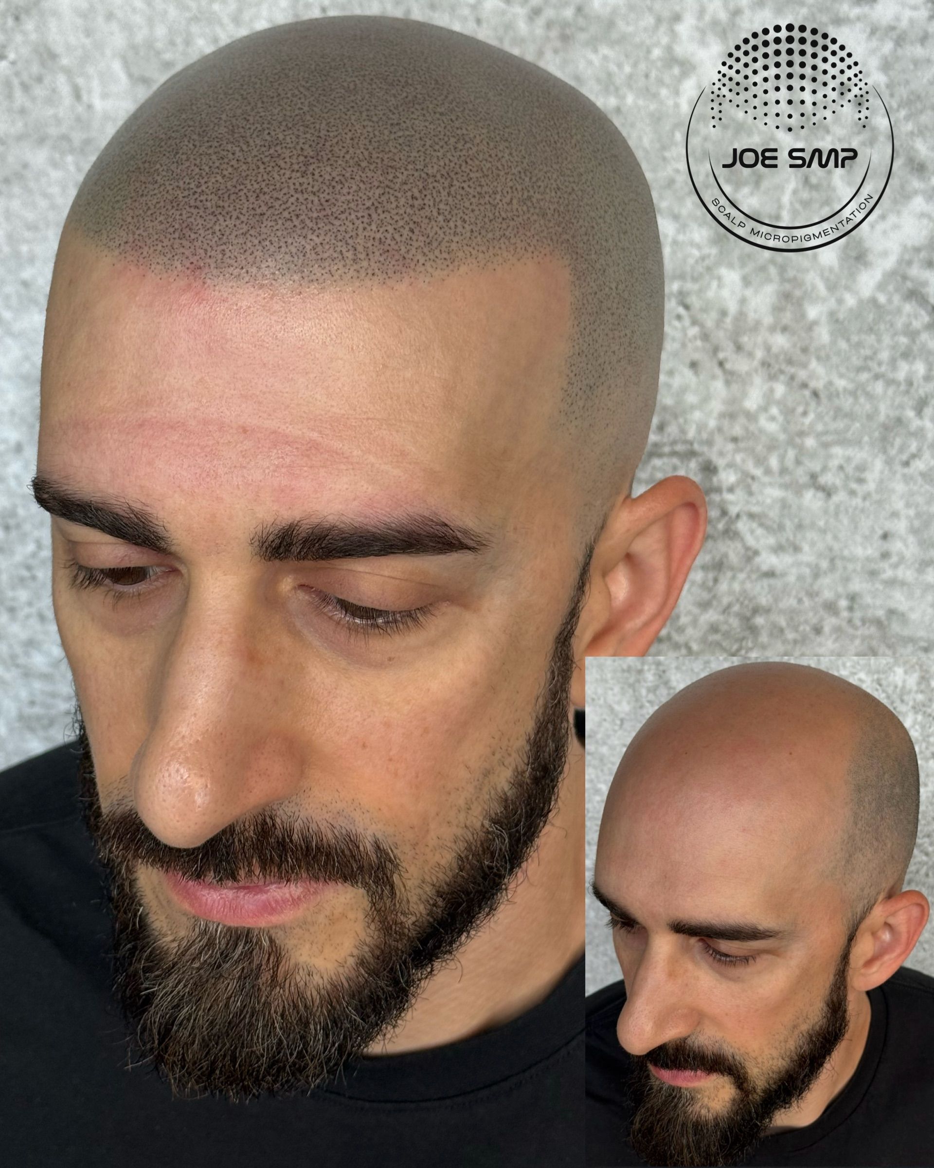 Man with scalp micropigmentation, showcasing a simulated hairline with a beard.