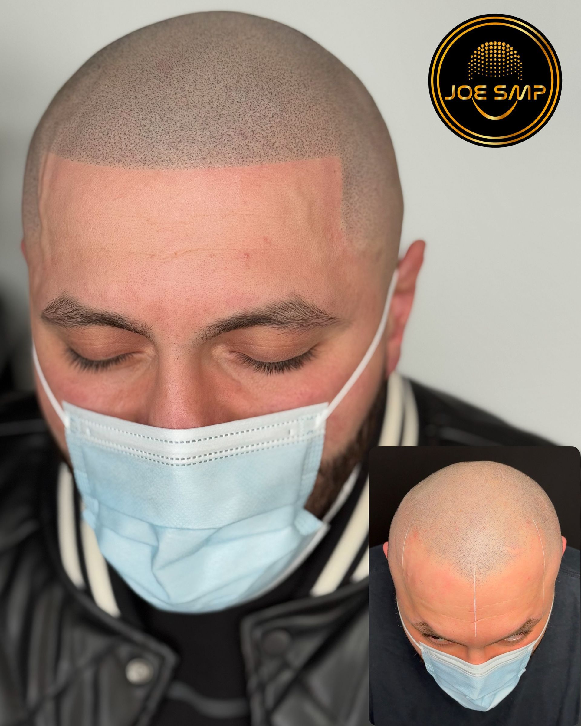 Man with scalp micropigmentation, wearing a mask. Inset of top-down view.