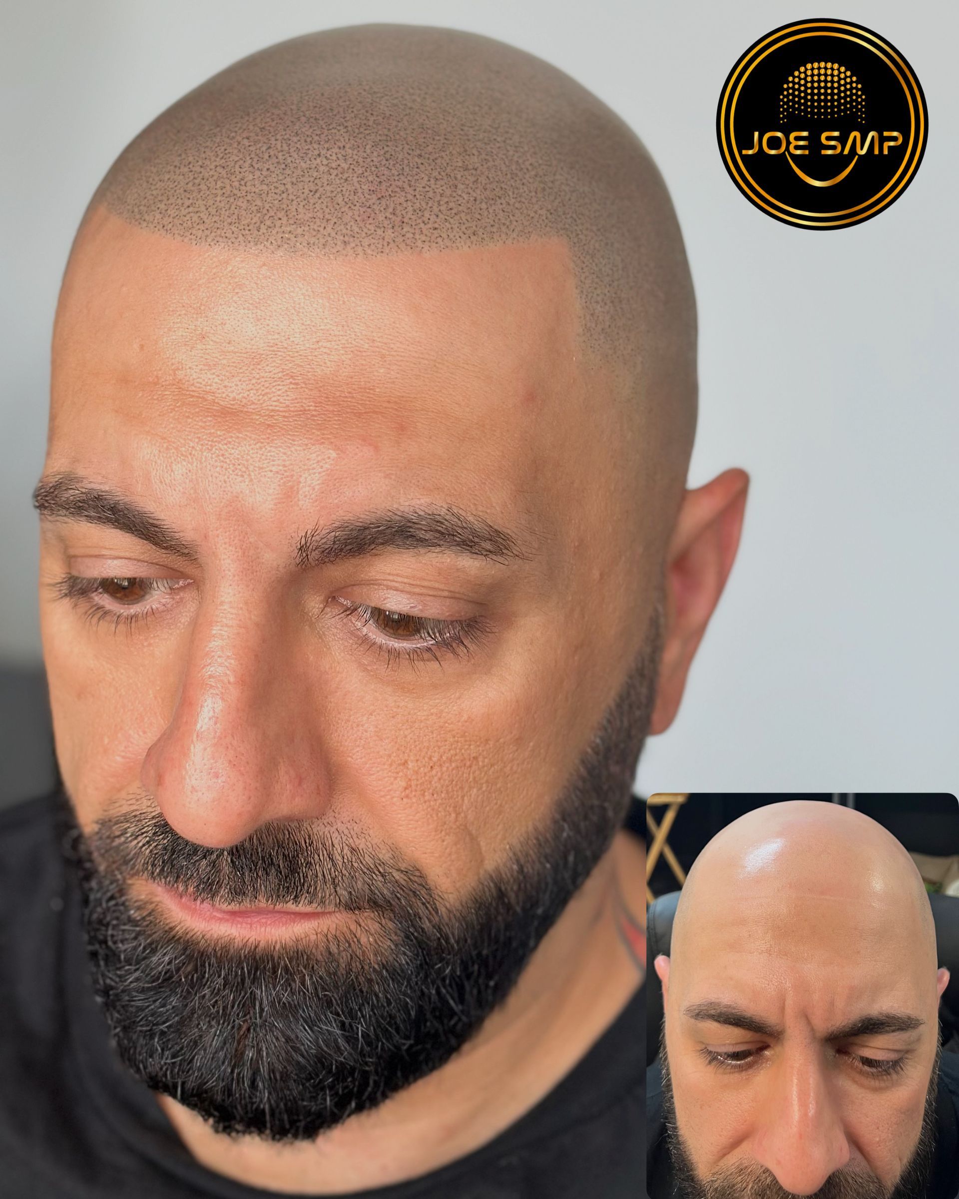 Man with scalp micropigmentation, showcasing before-and-after results. Beard, neutral expression.