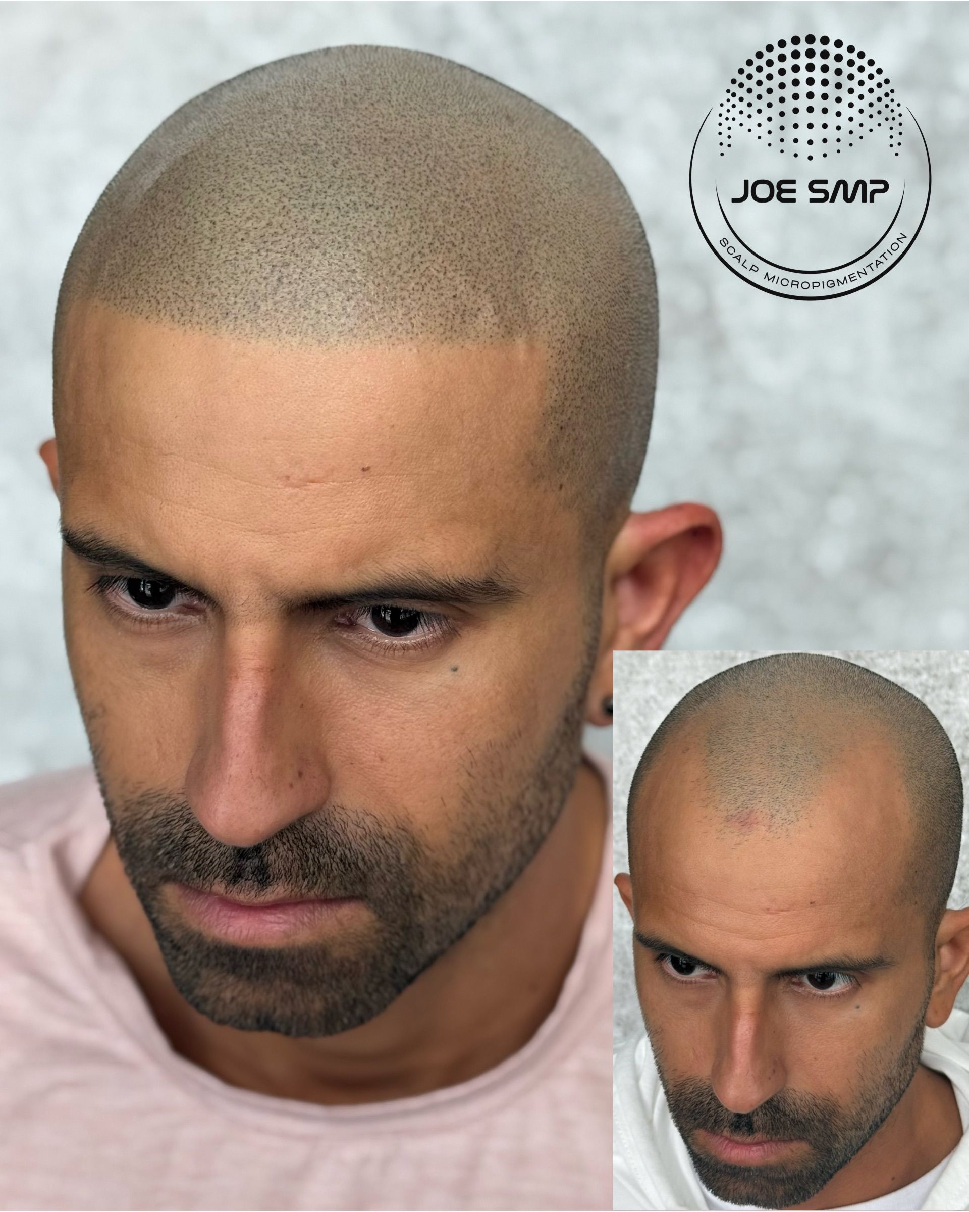 Man with scalp micropigmentation, showcasing simulated hair follicles. Small inset photo.