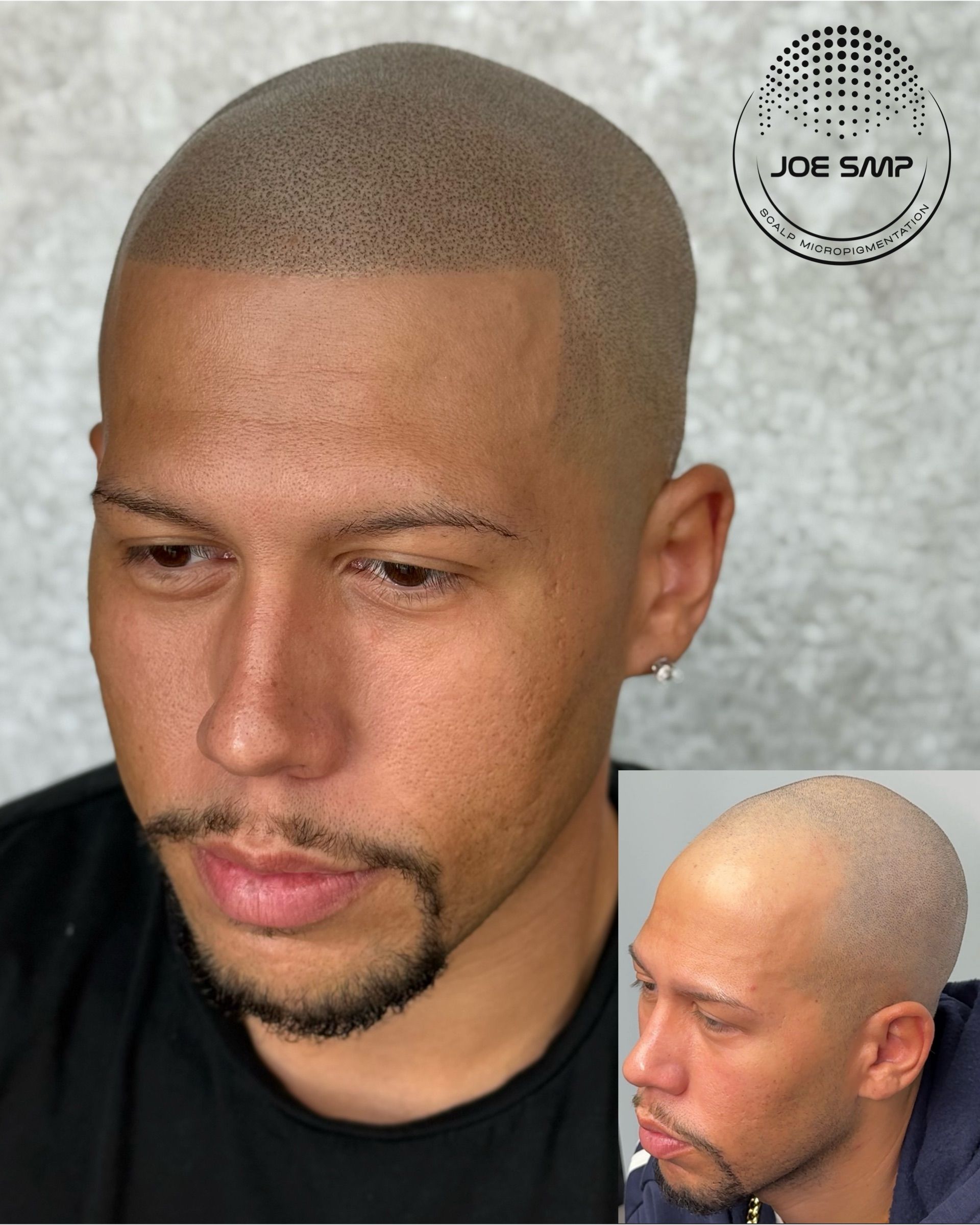 Man with scalp micropigmentation, showcasing a shaved head with a hairline; inset of profile view.