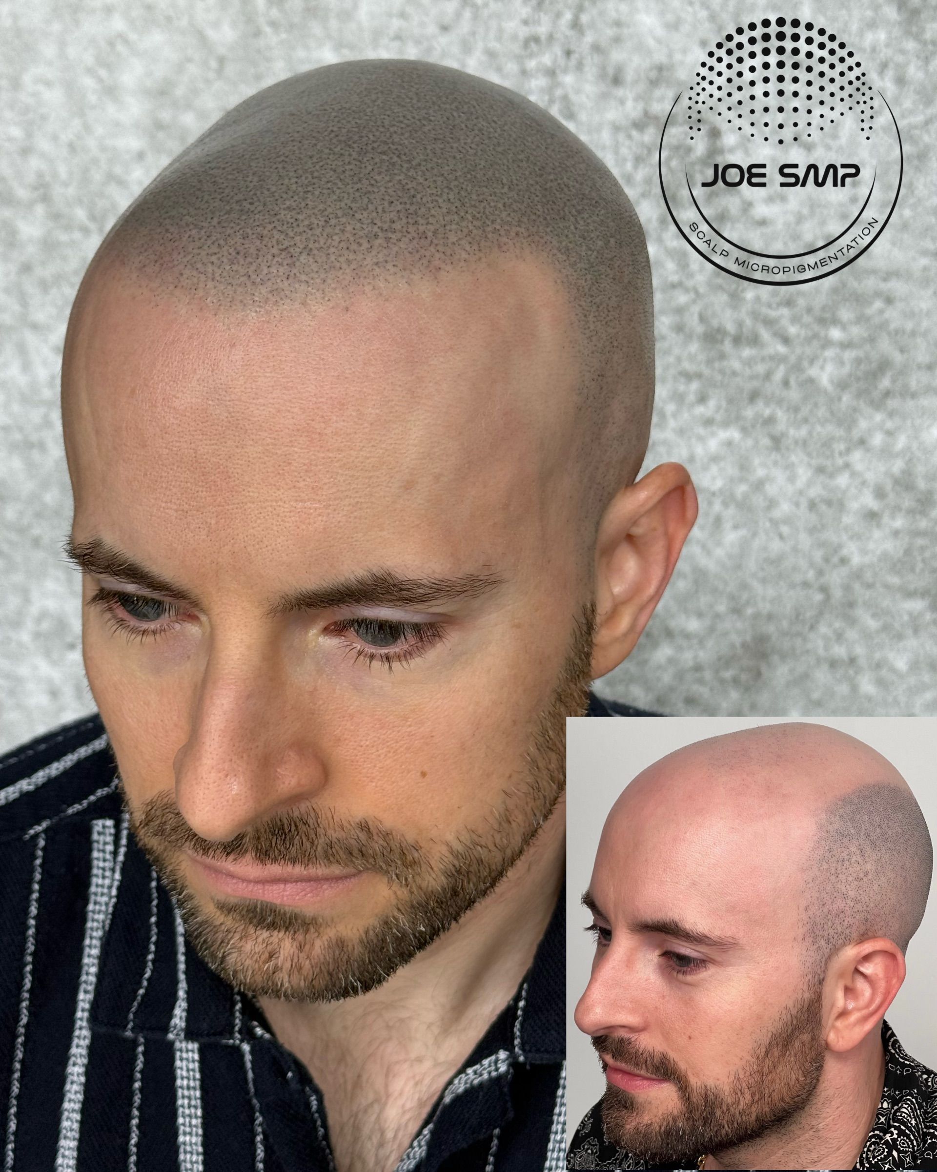 Man with scalp micropigmentation, showcasing a simulated shaved head. Side view comparison inset.