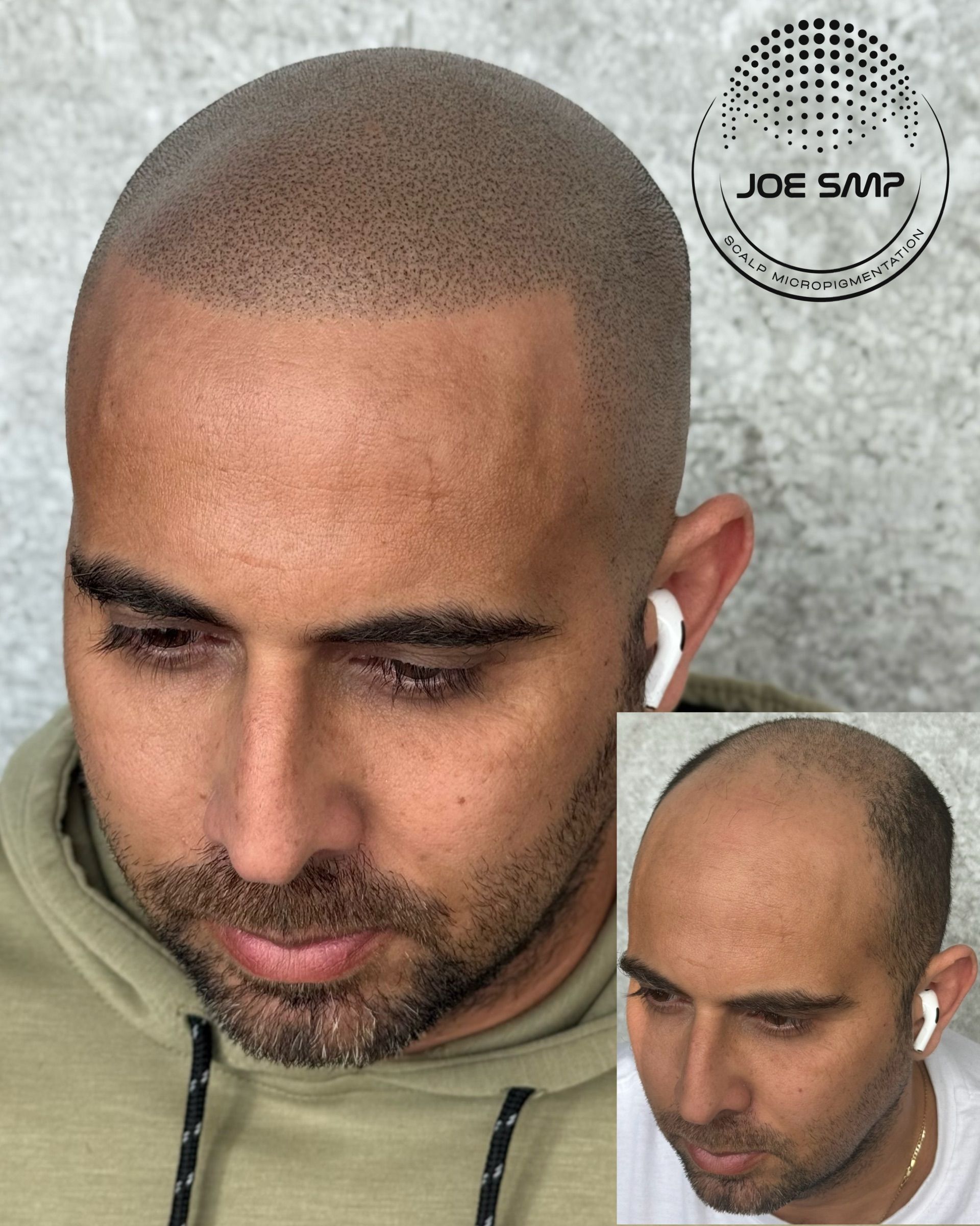 Man's head with scalp micropigmentation, before and after. Brown dots give the appearance of a shaved head.