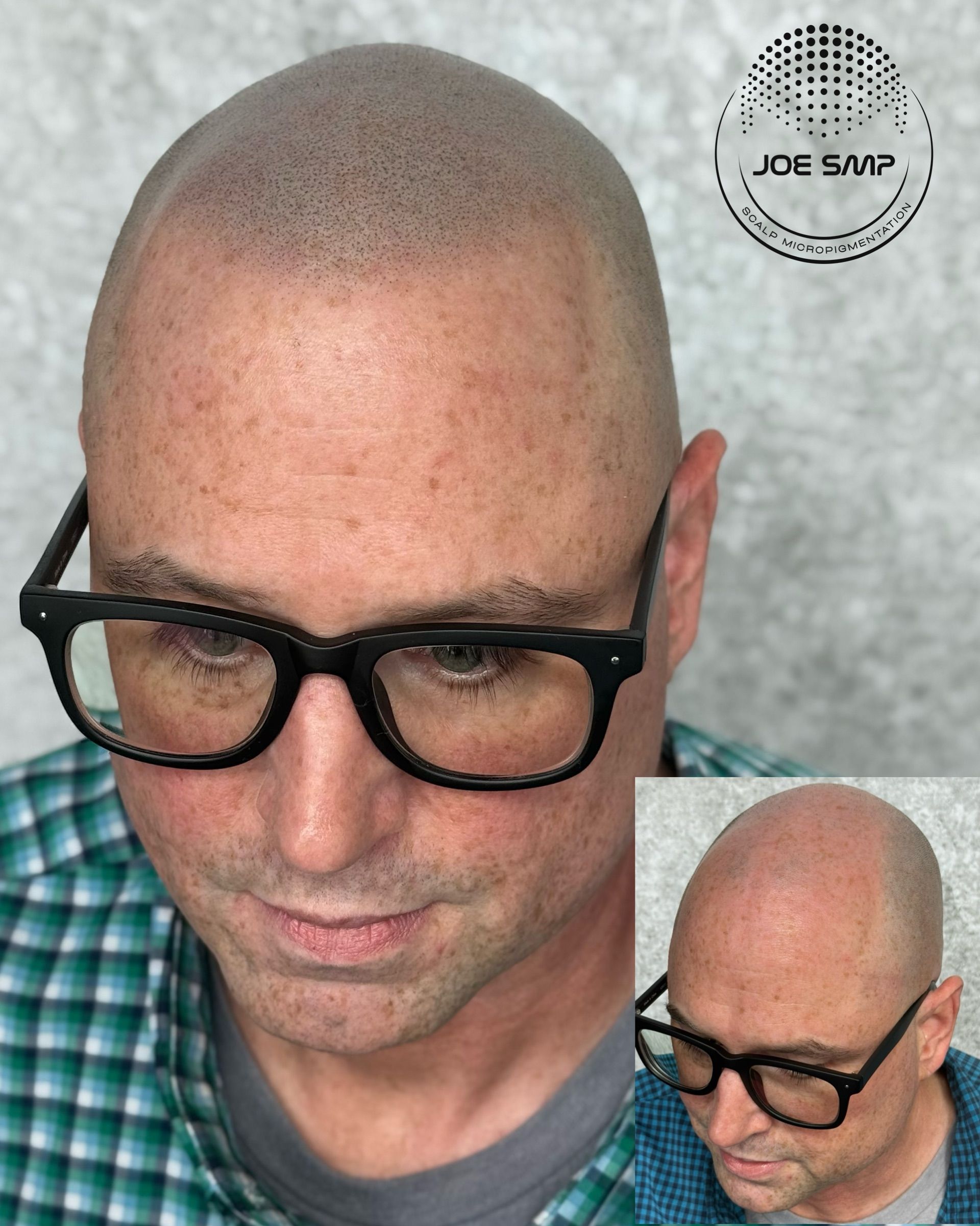 Man with shaved head and SMP procedure, wearing glasses, close-up shot, small inset image.