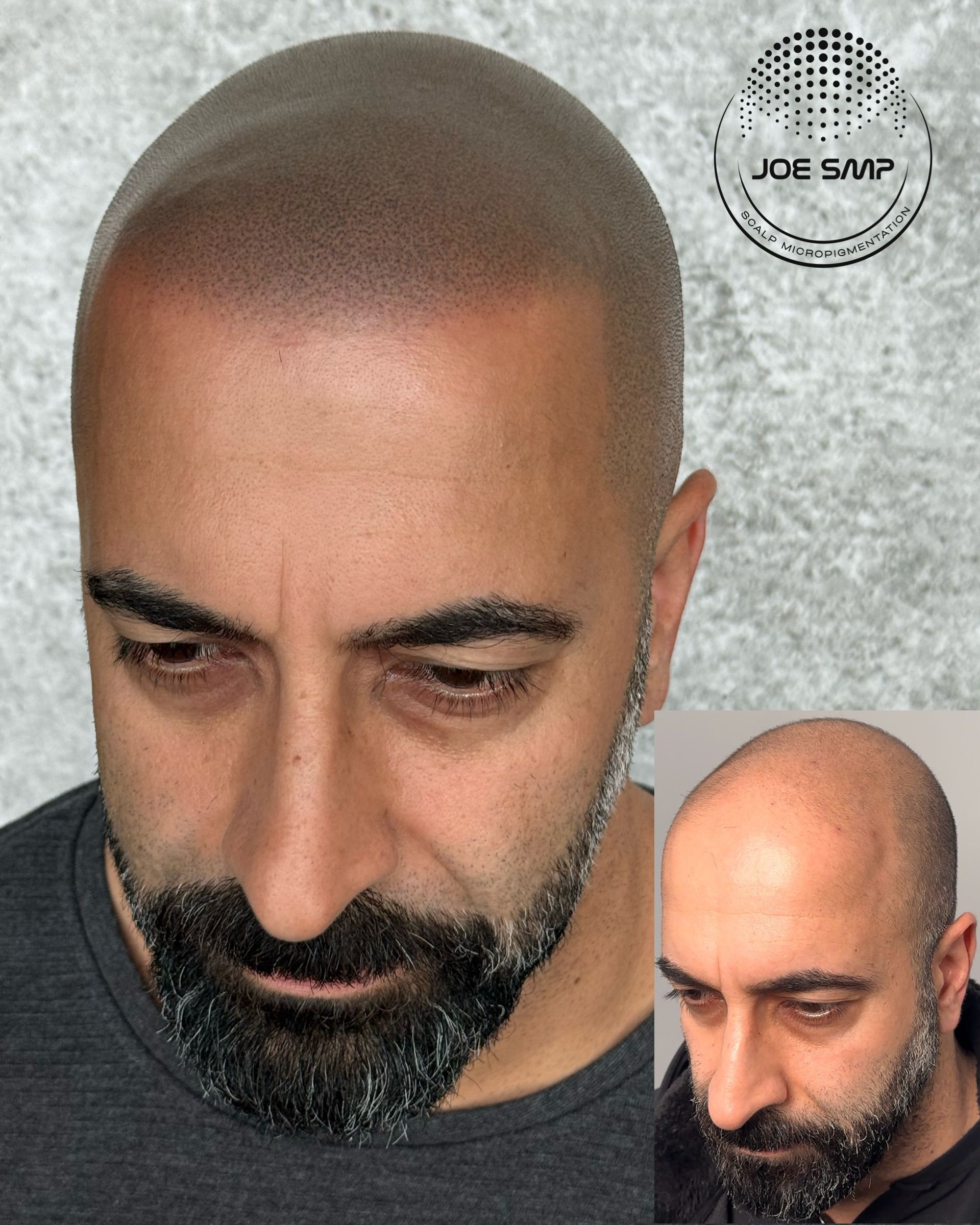 Man with shaved head and beard, receiving scalp micropigmentation. Inset shows before.