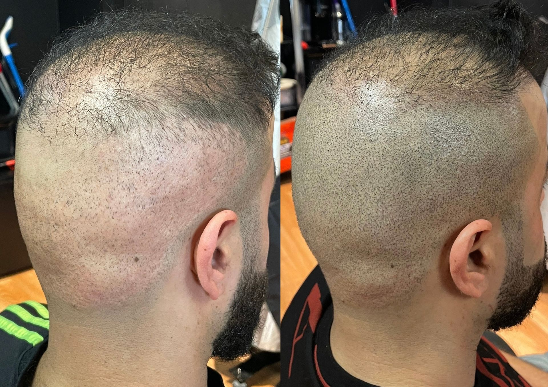 Before and after shots of a person's head; shaved hair in the 