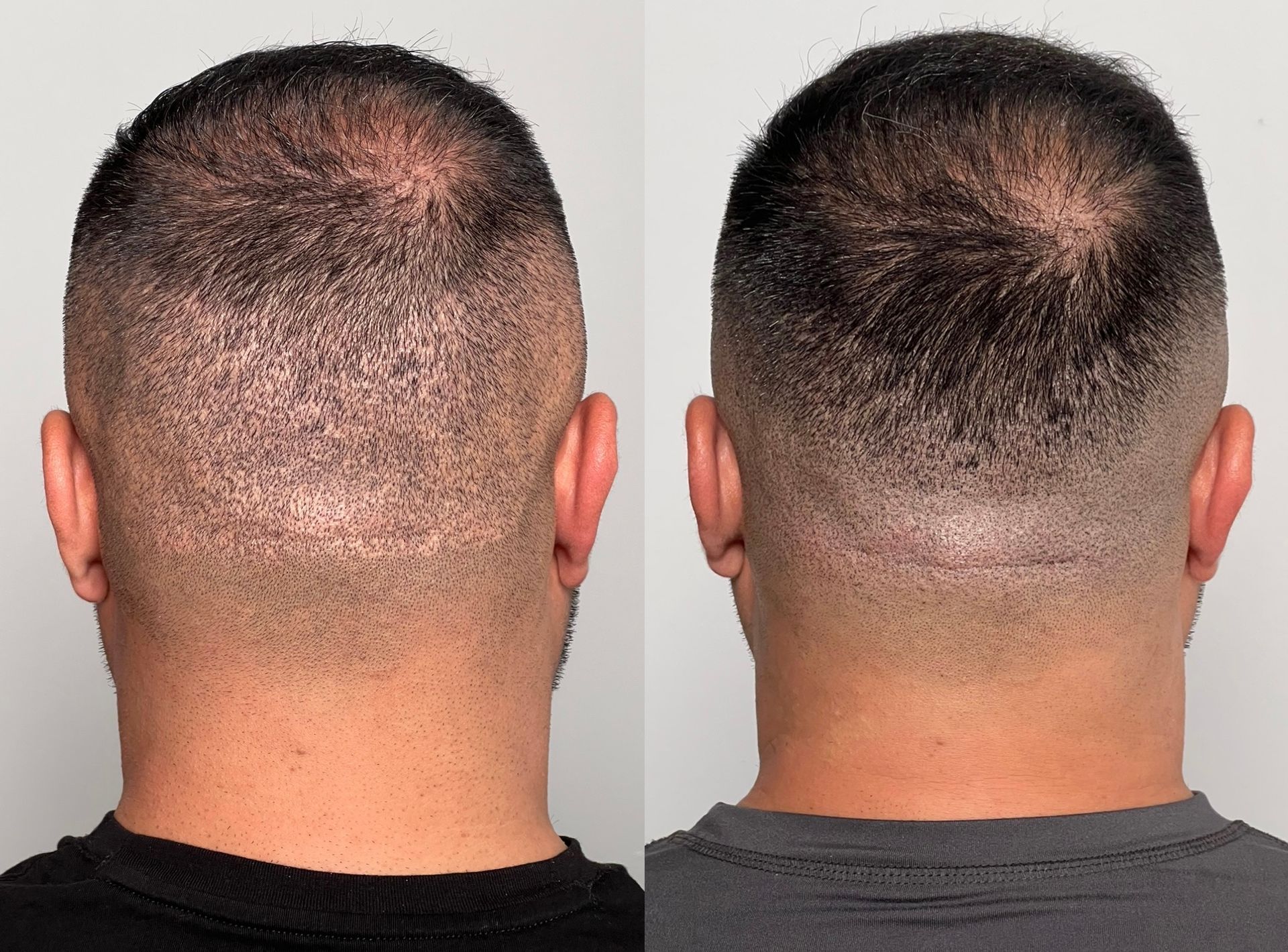 Two images showing a man's head from the back with a shaved haircut, before and after a procedure.