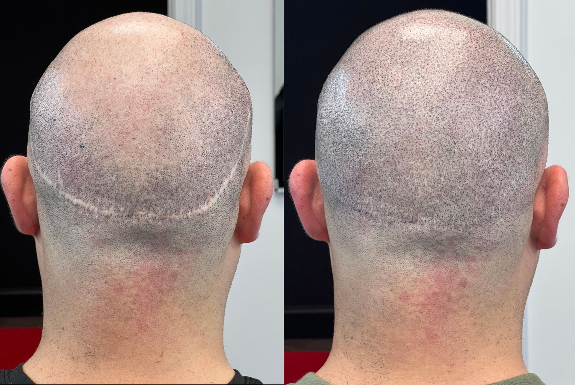 Comparison of a shaved head before (left) and after (right) hair transplant scar repair, showing back of the head.
