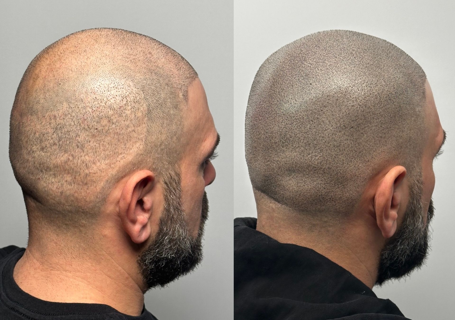 Side-by-side comparison of a man's head, showing hair loss before and after scalp micropigmentation.