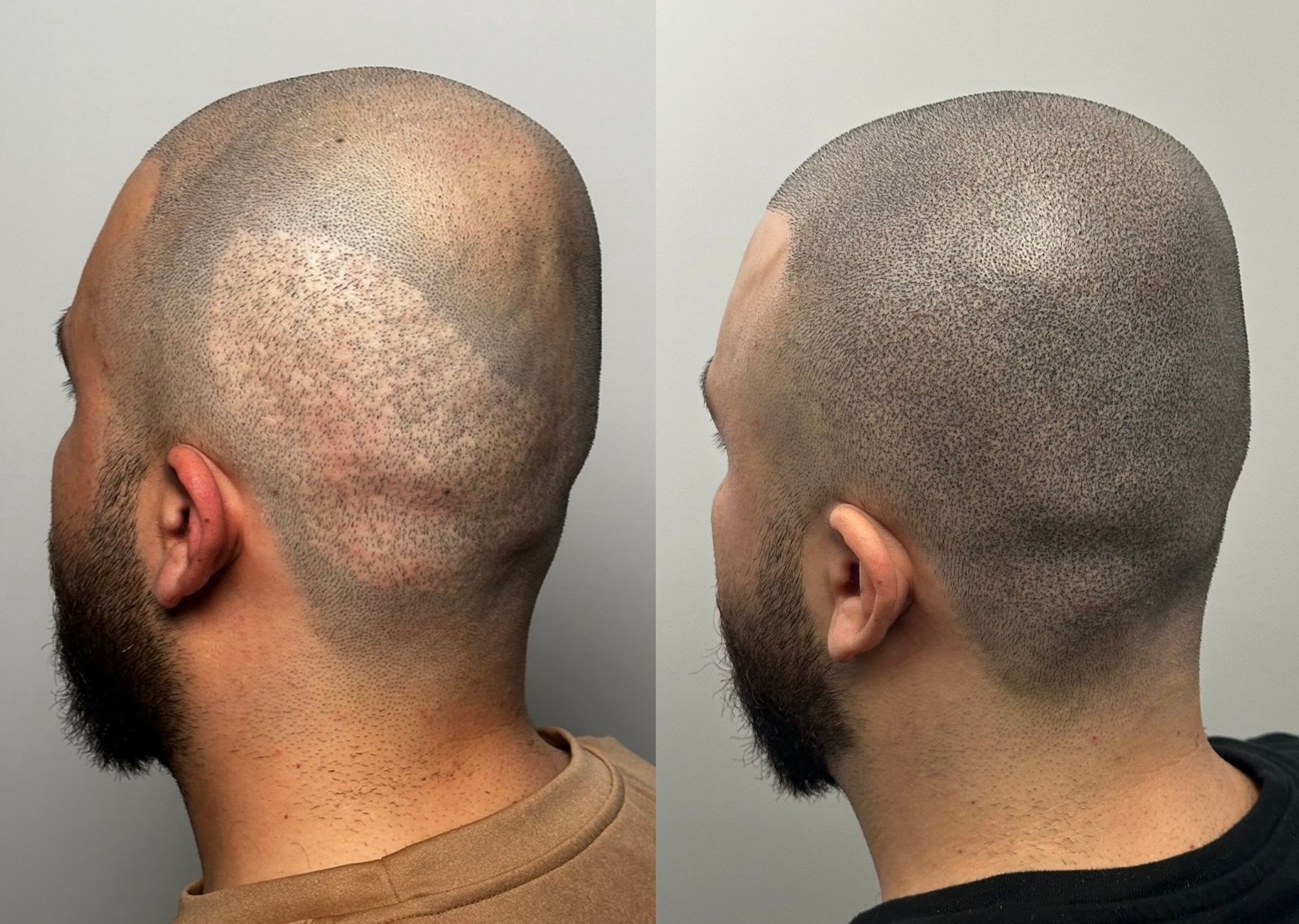 Before and after of a shaved head with scalp micropigmentation, filling in areas of hair loss, with improved density and appearance.