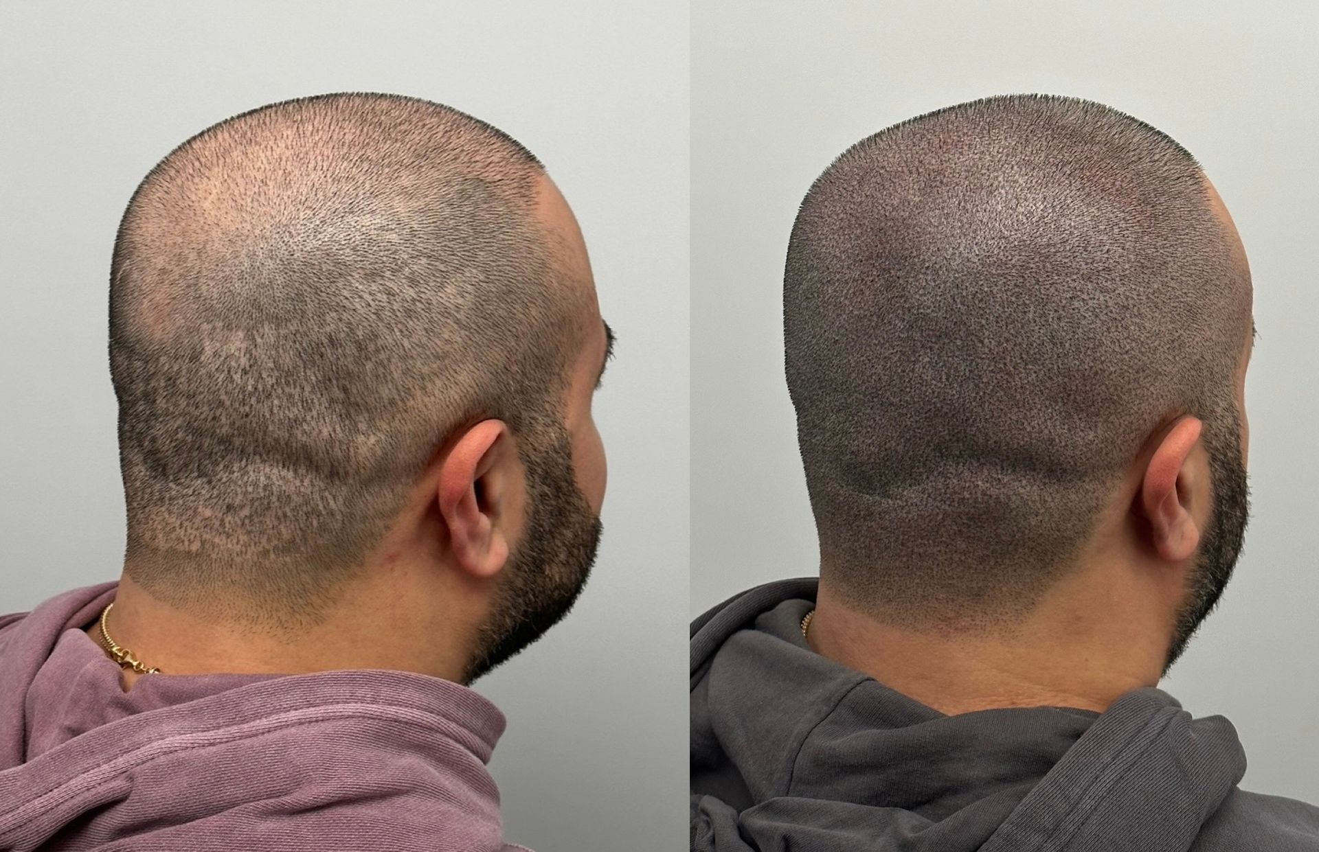 Two side-by-side views of a man's head, showing hair loss on the crown before (left) and after (right) a hair procedure.