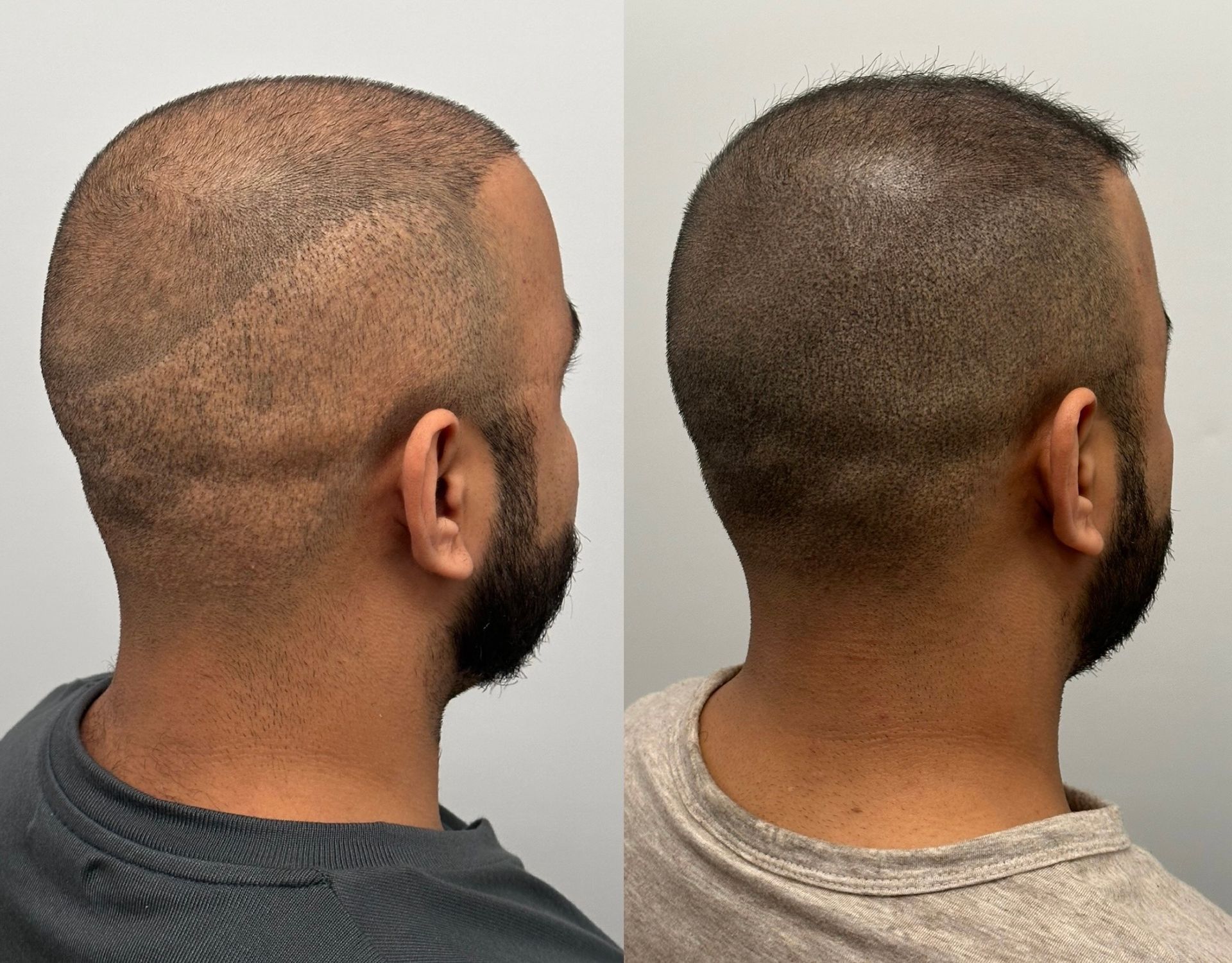 Before-and-after of a shaved head. The right side shows thicker hair coverage than the left.