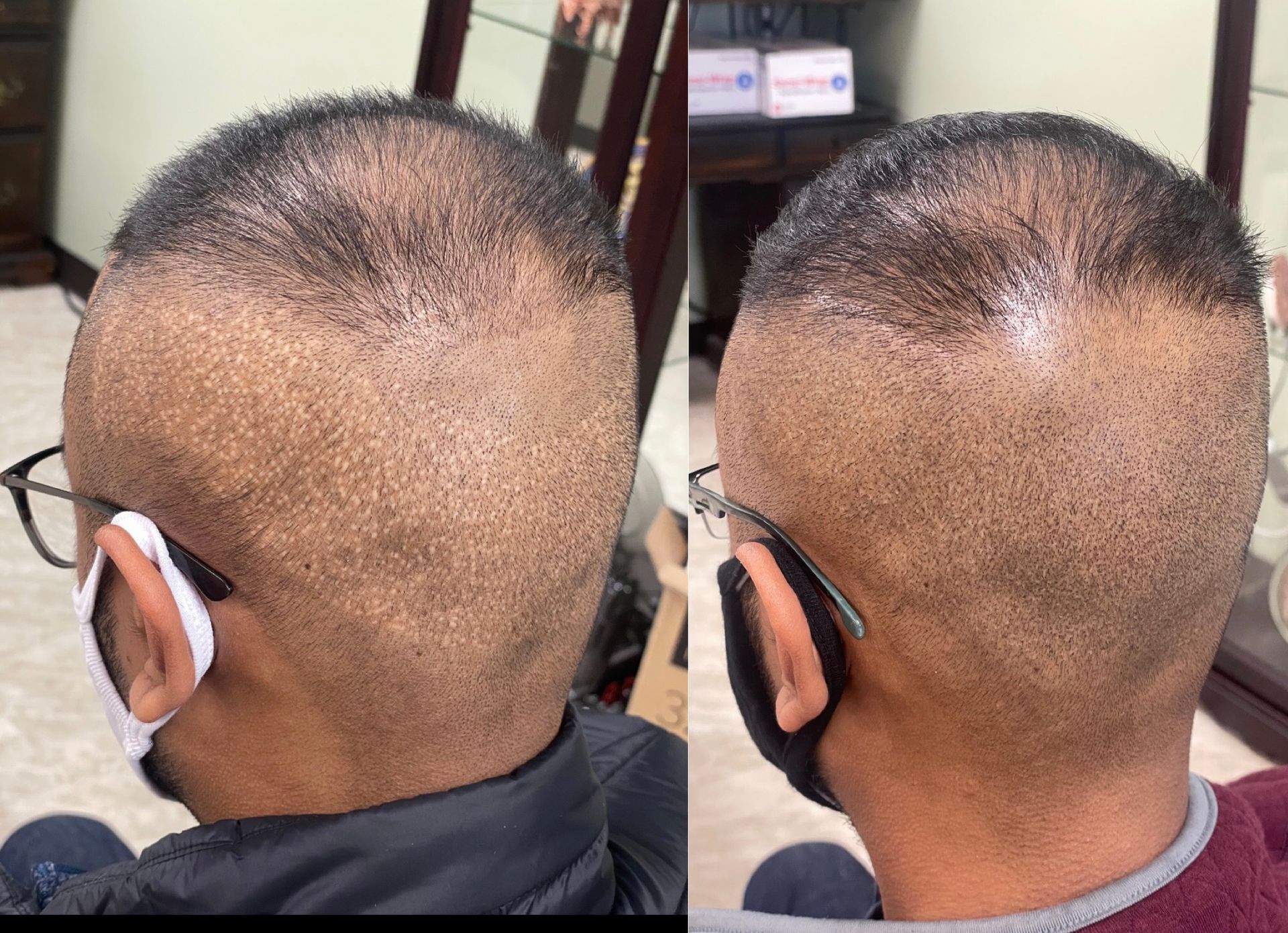 Two views of a person's head, showing hair loss.  The scalp is shaved, highlighting sparse hair growth.  Face mask visible.