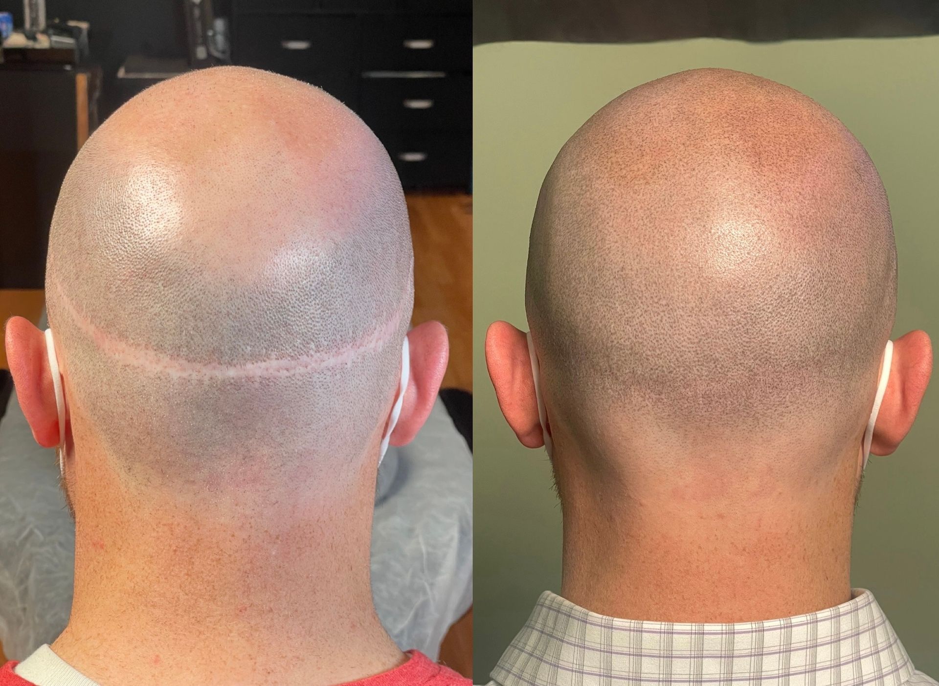 Before and after scalp micropigmentation, showcasing a receding hairline correction.