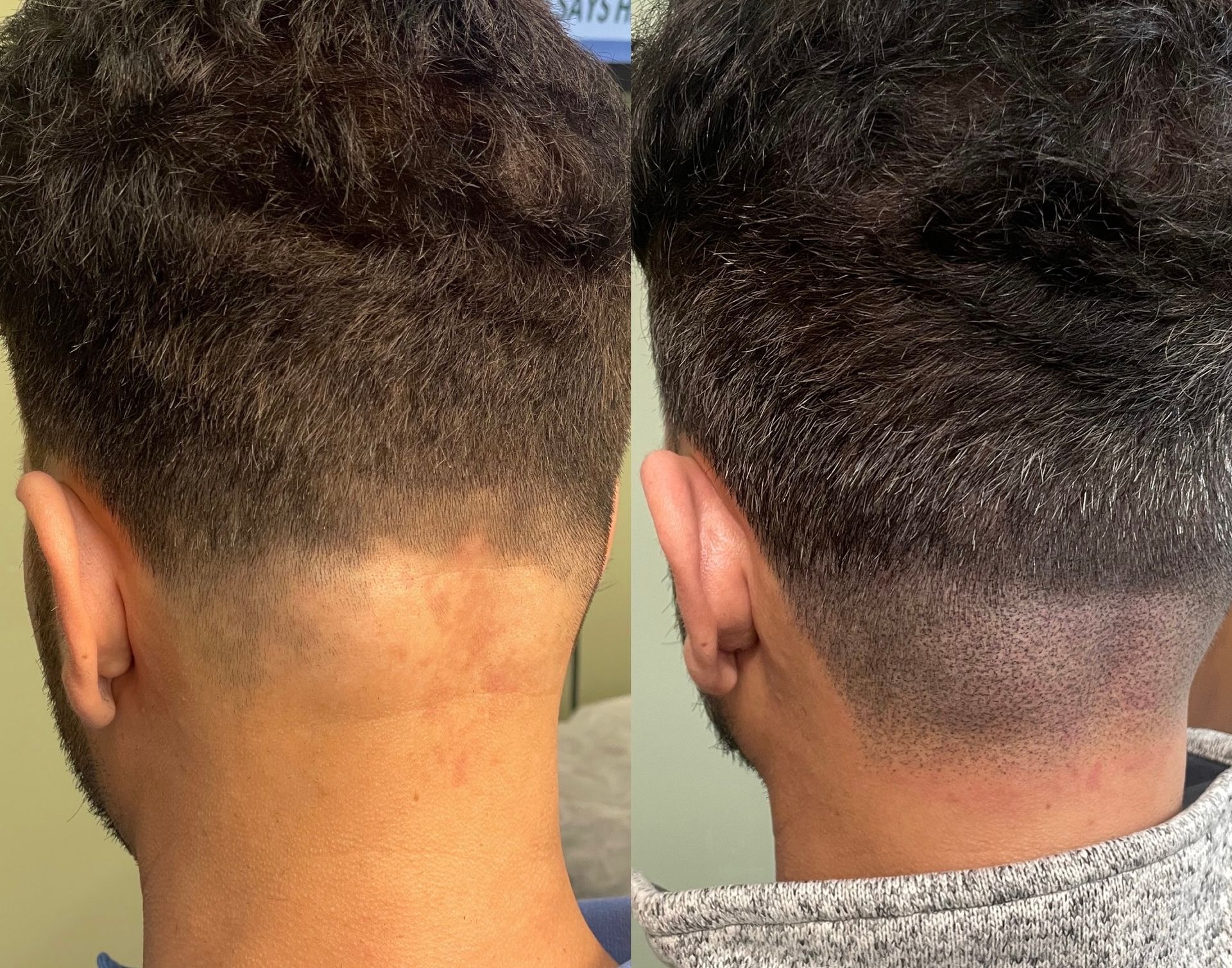 Two side-by-side images of the back of a person’s head. Haircut progress is visible with a skin discoloration.