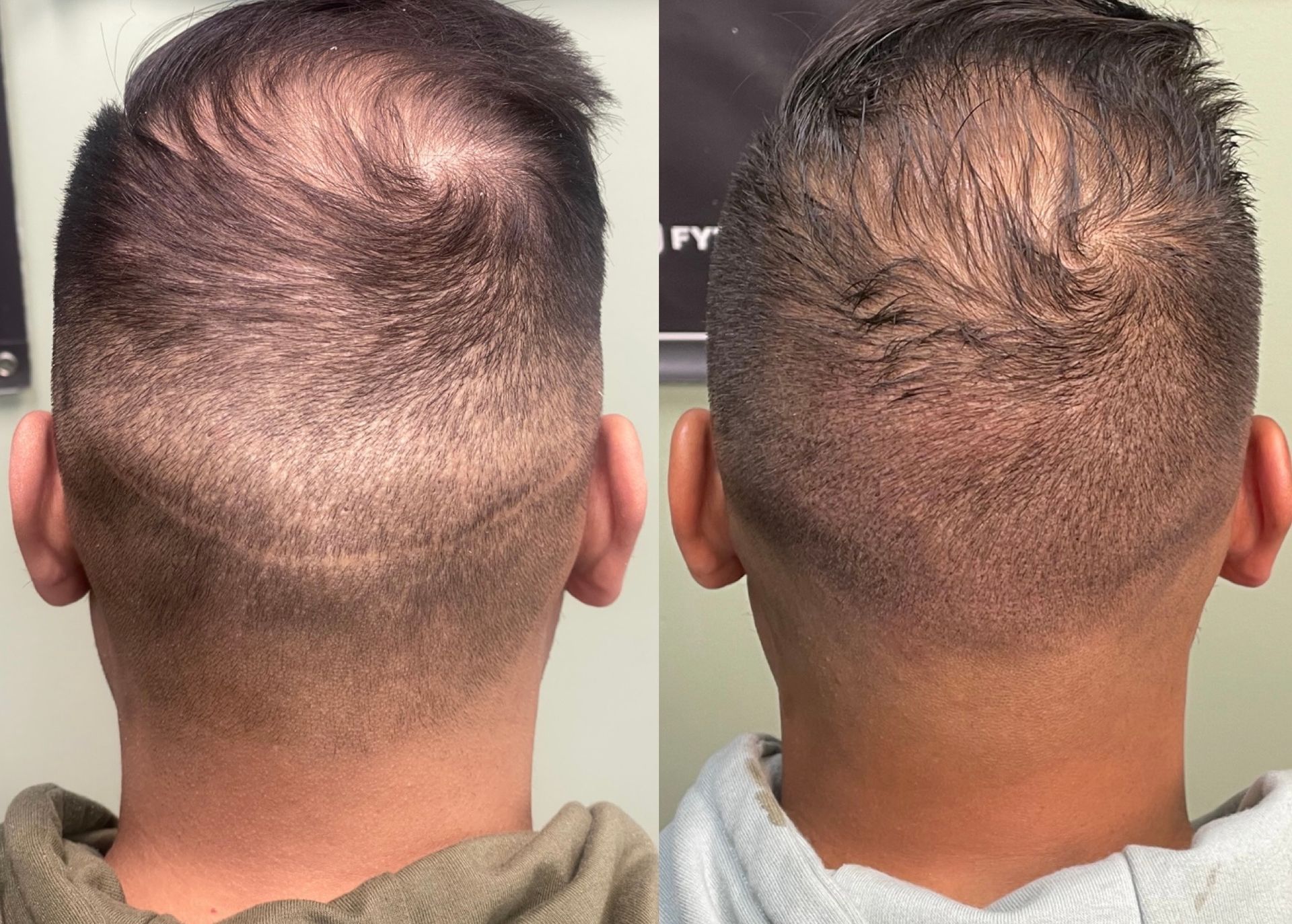 Two views of a man's head, showing hair loss. Left shows a scar, right shows a fuller hairline.
