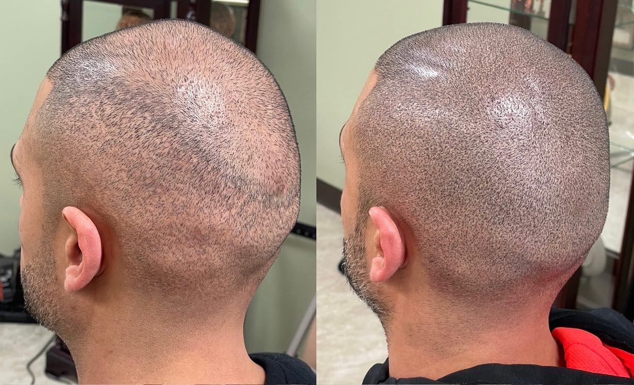 Two views of a head with scalp micropigmentation, showcasing a shaved head with tiny dots.