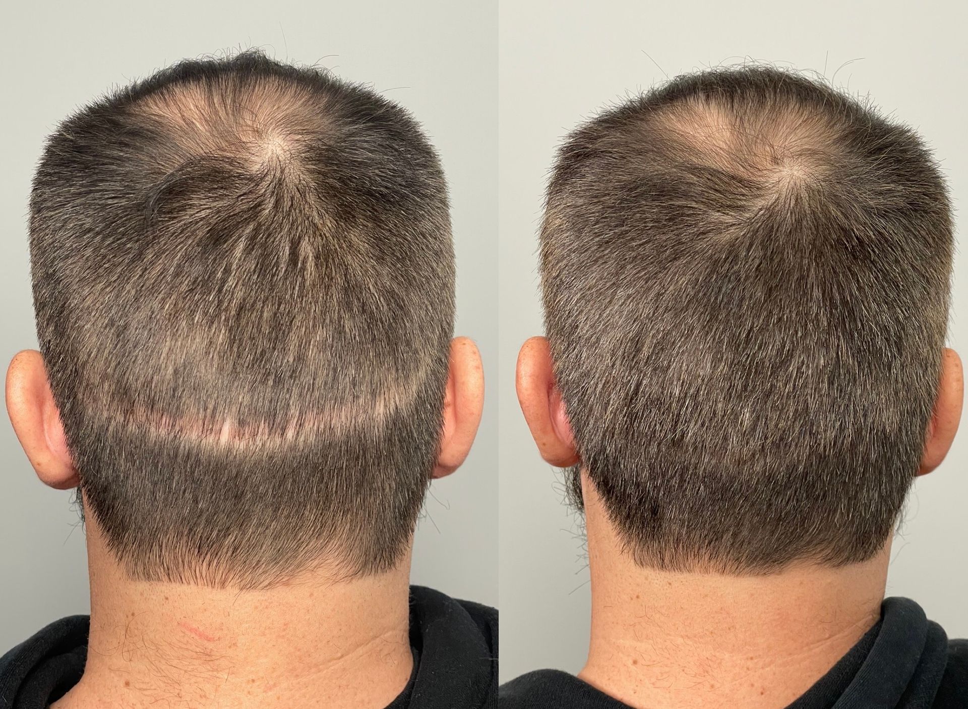 Two views of a man's head, showing a scar at the back, before and after hair growth.
