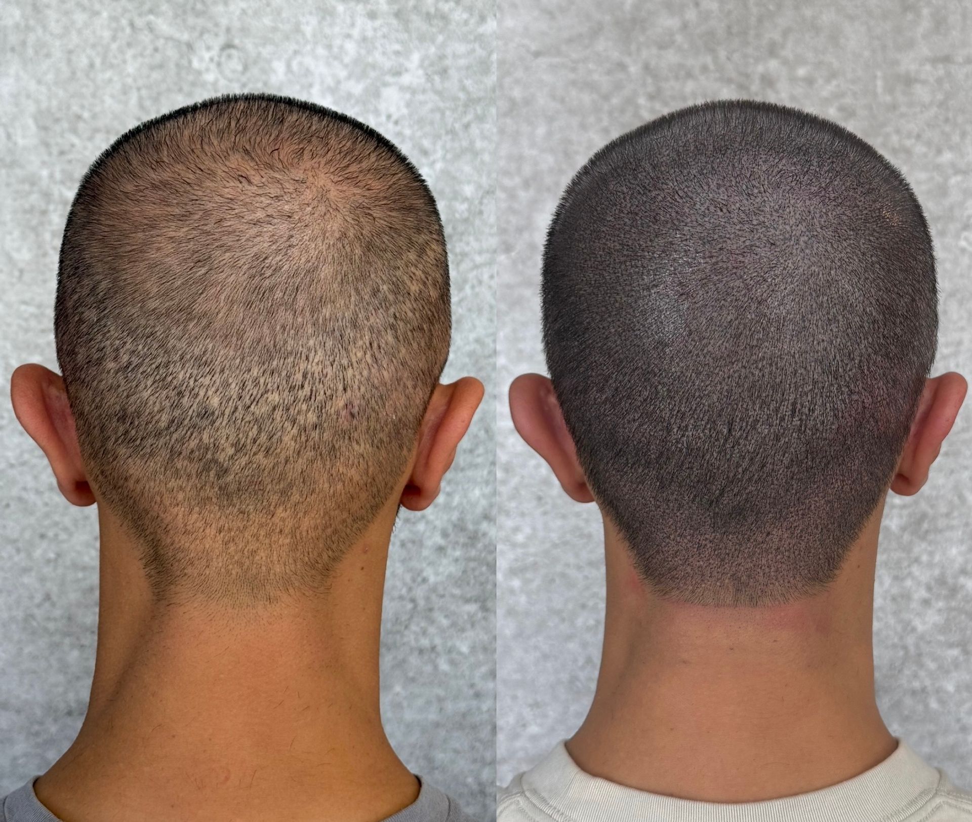 Two views of a shaved head; left before, right after Scalp Micropigmentation (SMP), appearing darker.