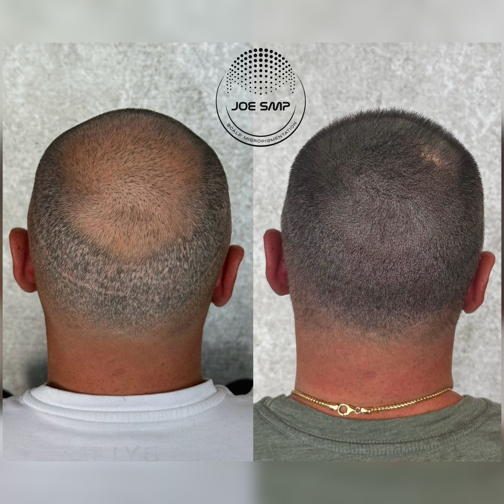 Before and after of a shaved head with scalp micropigmentation to address hair loss.
