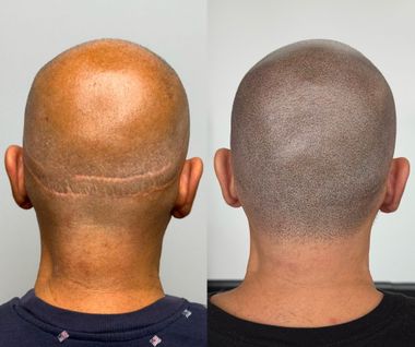 Before-and-after of a shaved head; left shows a scar, right shows scalp micropigmentation, giving the appearance of stubble.